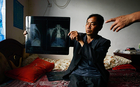 A migrant worker diagnosed with pneumoconiosis shows his chest X-ray. Photo: SCMP Pictures