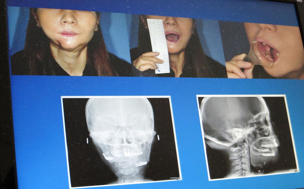 X-rays and photographs of Yik Siu-ling before her treatment.