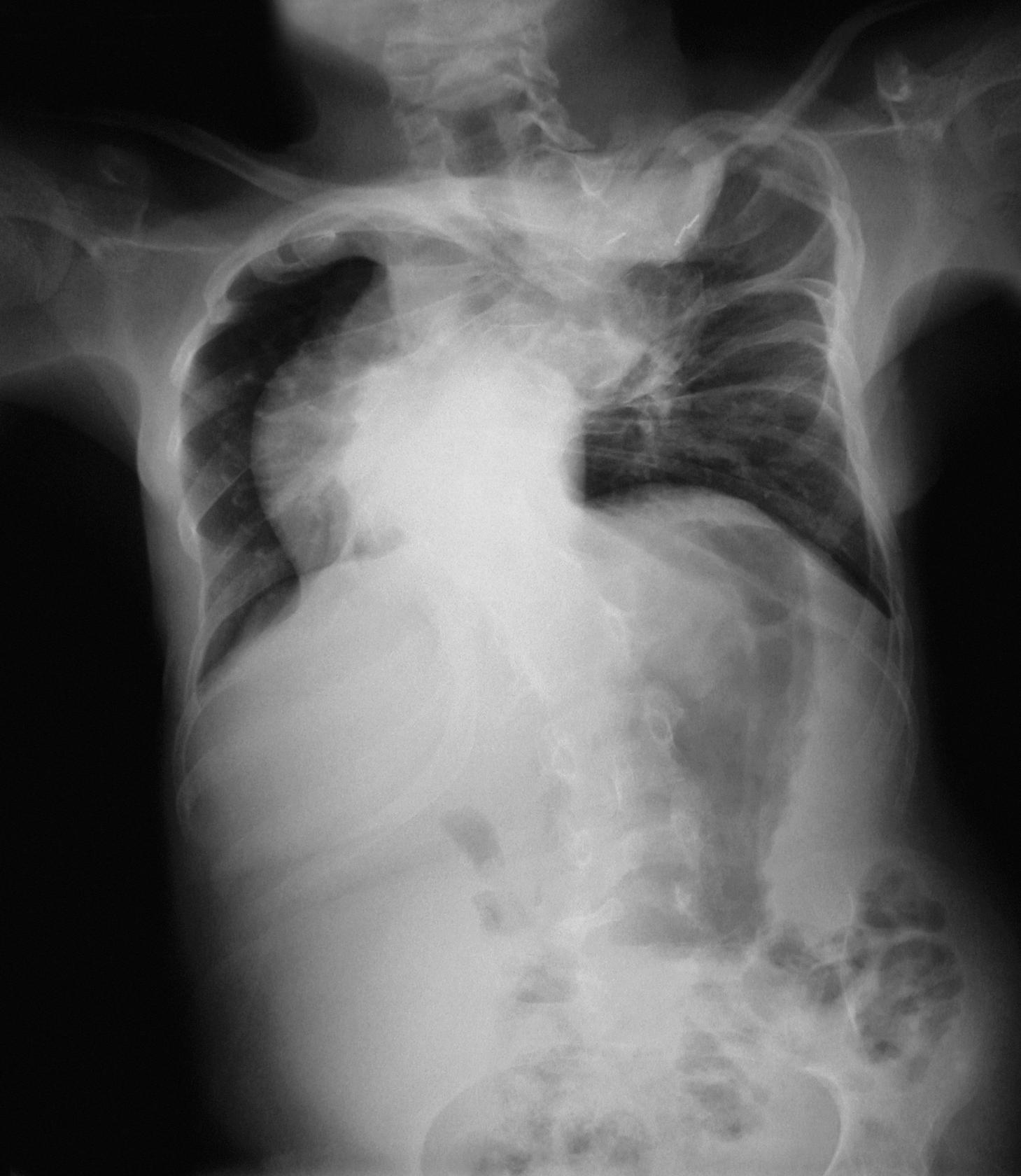 pigeon chest x ray