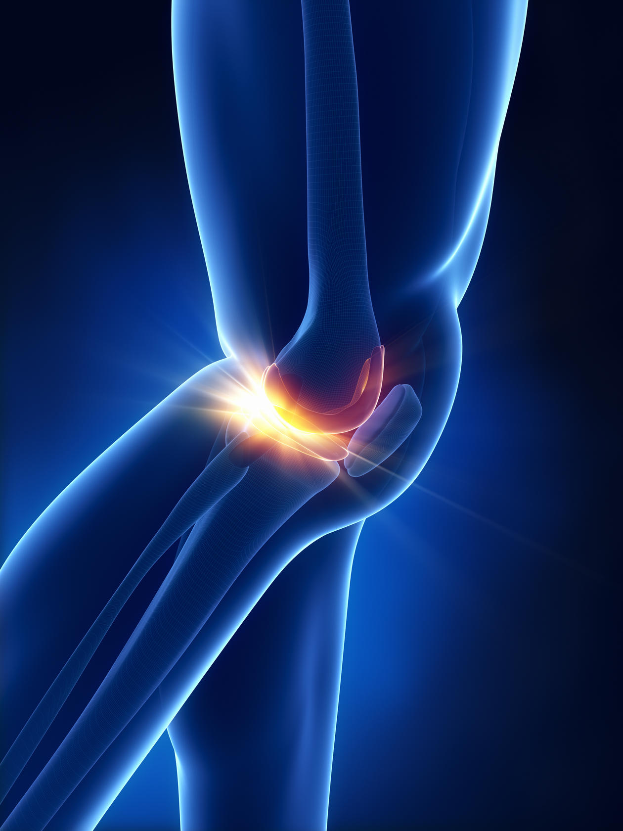 Osteoarthritis results in a breakdown of cartilage in joints.