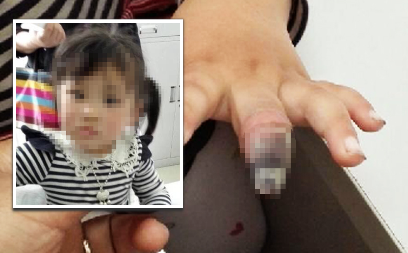 Doctors in Suzhou said poor blood circulation, caused by the tight binding around the tip of her finger, caused it to turn black. Photo: weibo