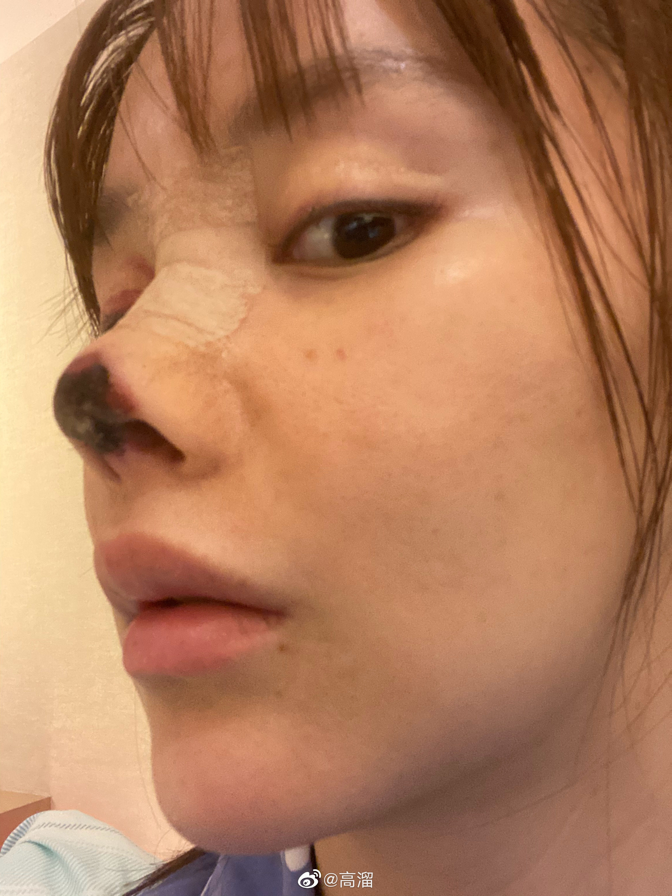 Gao Liu posted candid pictures of her post-surgery face showing part of her nose blackened with dead flesh. Photo: Weibo