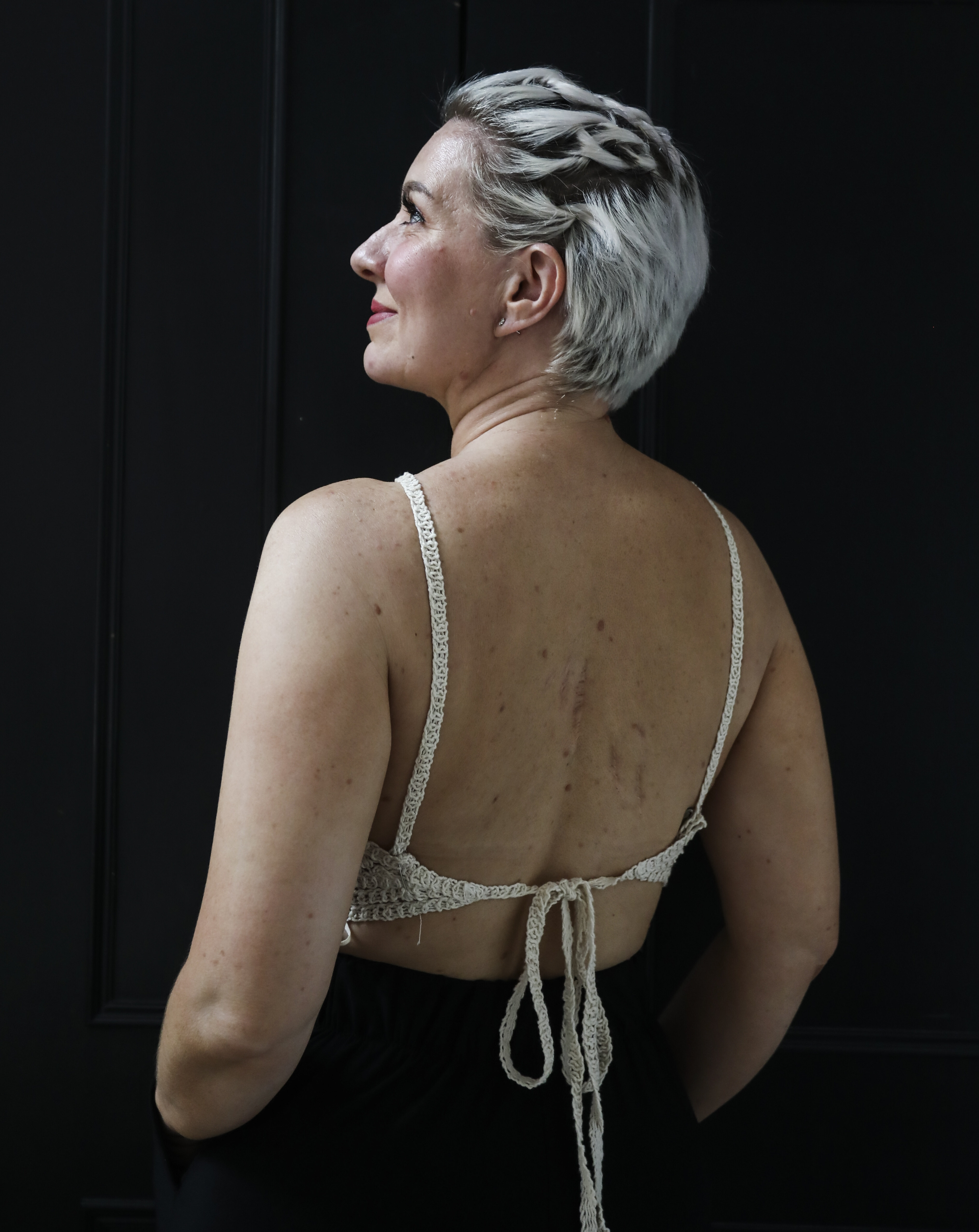 Adele Hughes, her back scarred from skin cancer. Photo: Jonathan Wong