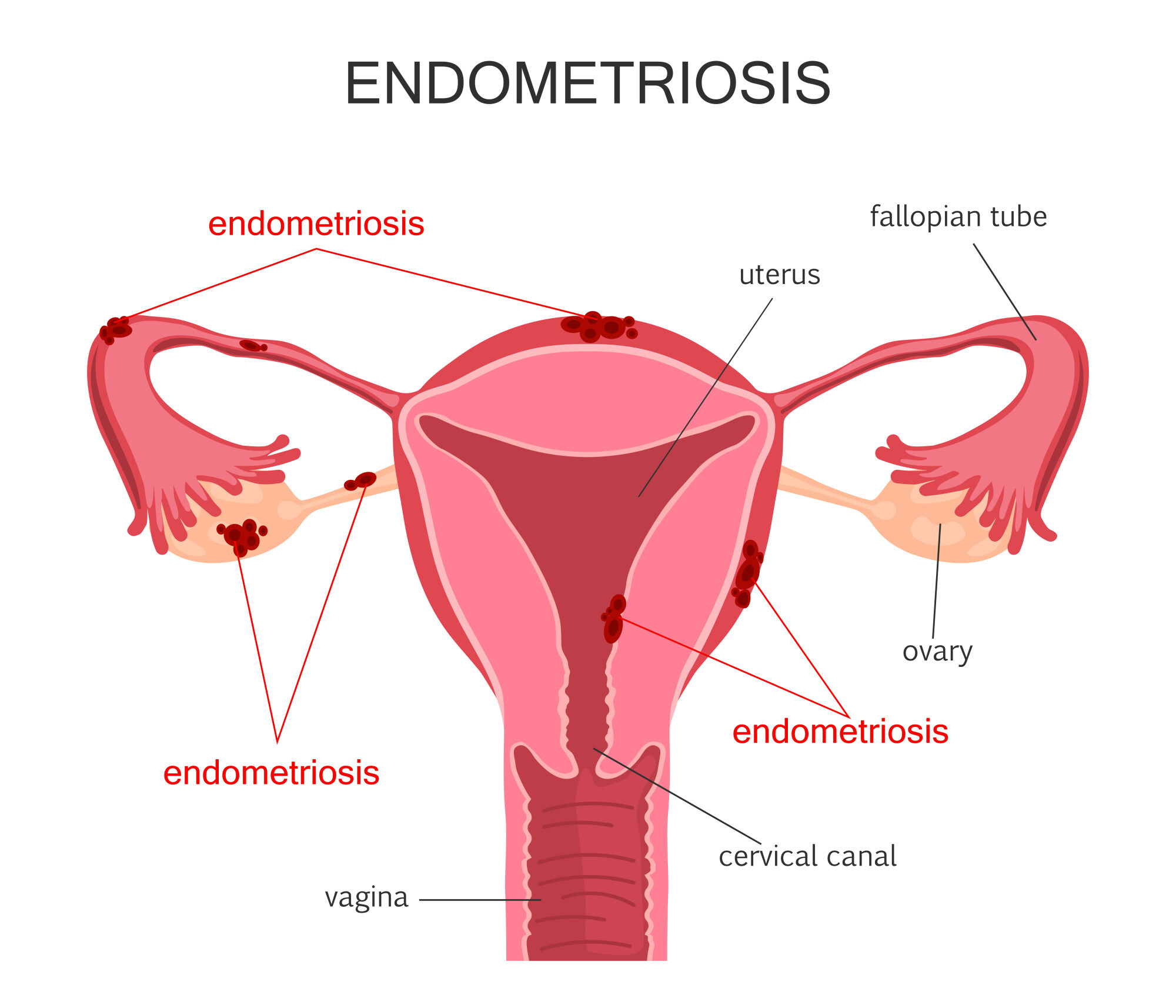 Period Pain: Could It Be Endometriosis?