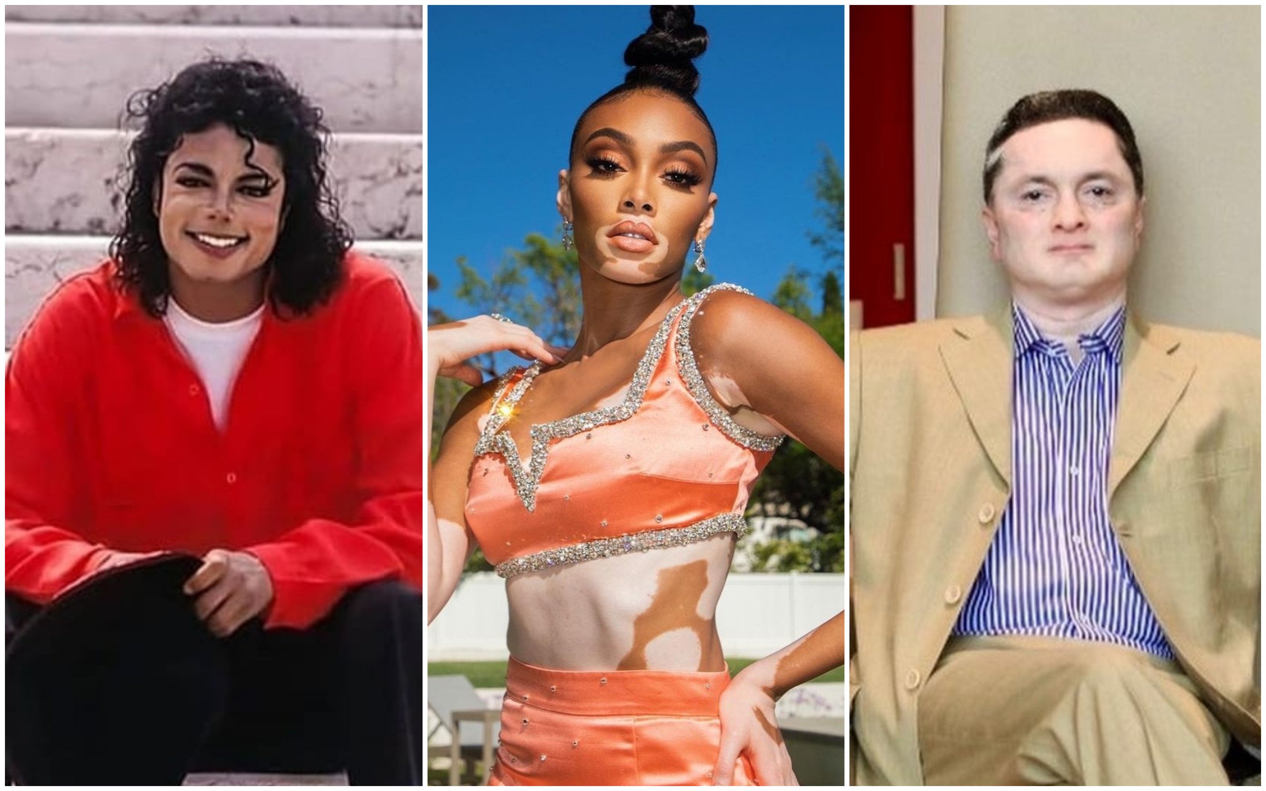 From left, Michael Jackson, model Winnie Harlow and Indian billionaire Gautam Singhania, who are among the celebrities with vitiligo, a condition that results in a whitening of the skin. Photos: @__m.j.the.king__, @winnieharlow, @gautamsinghania99/Instagram