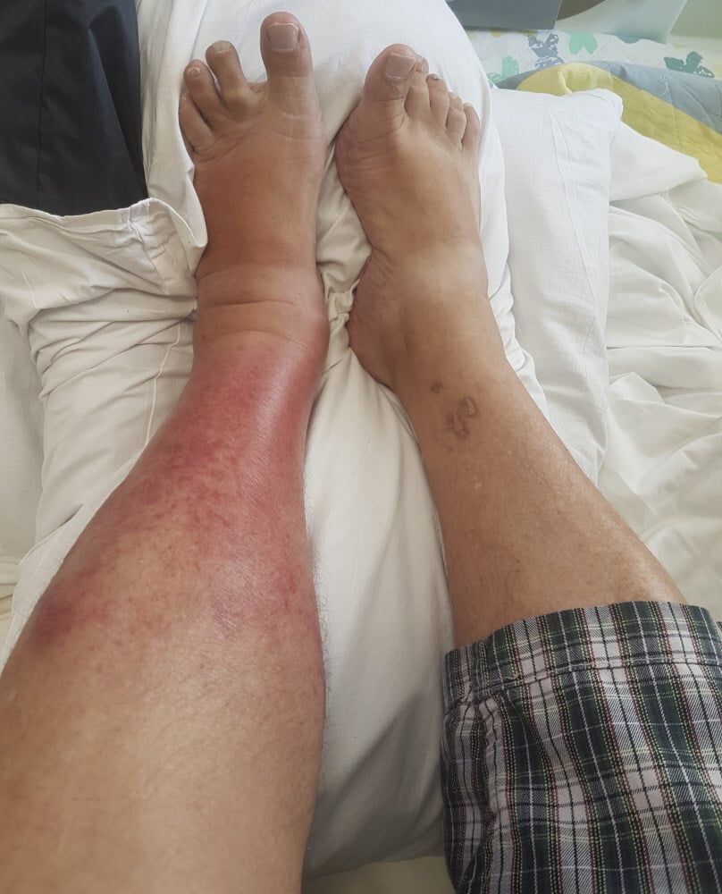 cellulitis infection