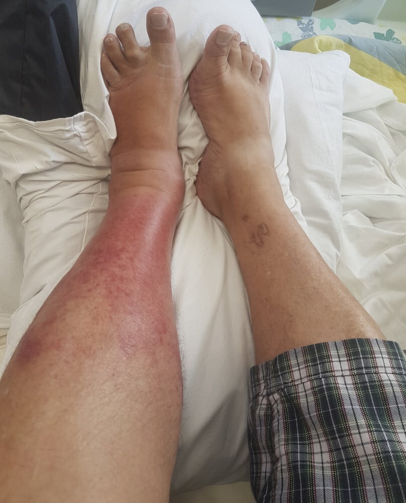 cellulitis bottom of foot