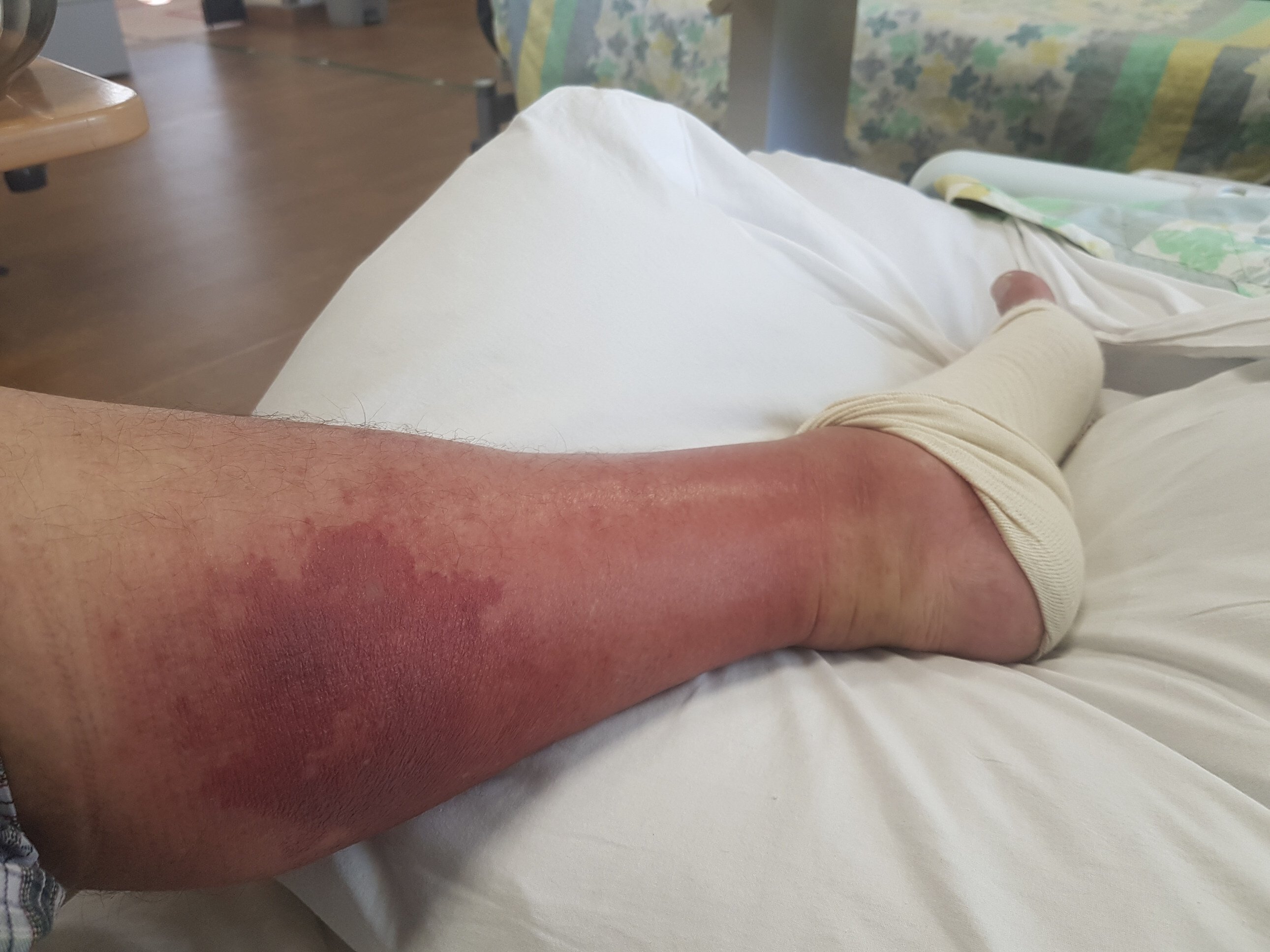 Martin Williams’ left leg doubled in size and turned purple after he contracted cellulitis, likely the result of stepping on a small sea creature at Cheung Sha beach on Lantau Island in Hong Kong. Photo: Martin Williams
