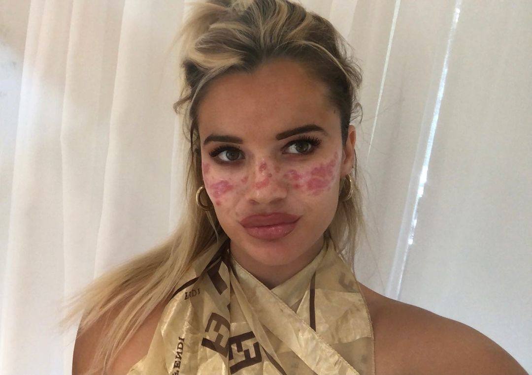 Bandages for acne? Experts weigh in on viral TikTok hack - ABC News