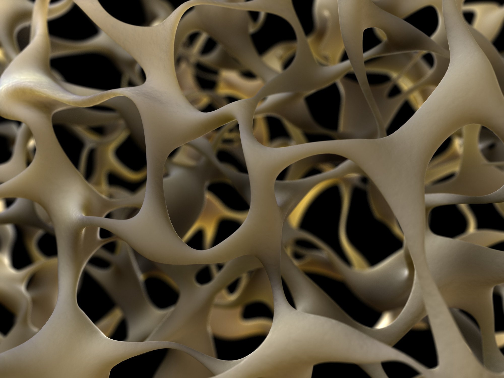 World Osteoporosis Day how to spot the bone thinning condition early, and ways to head it off