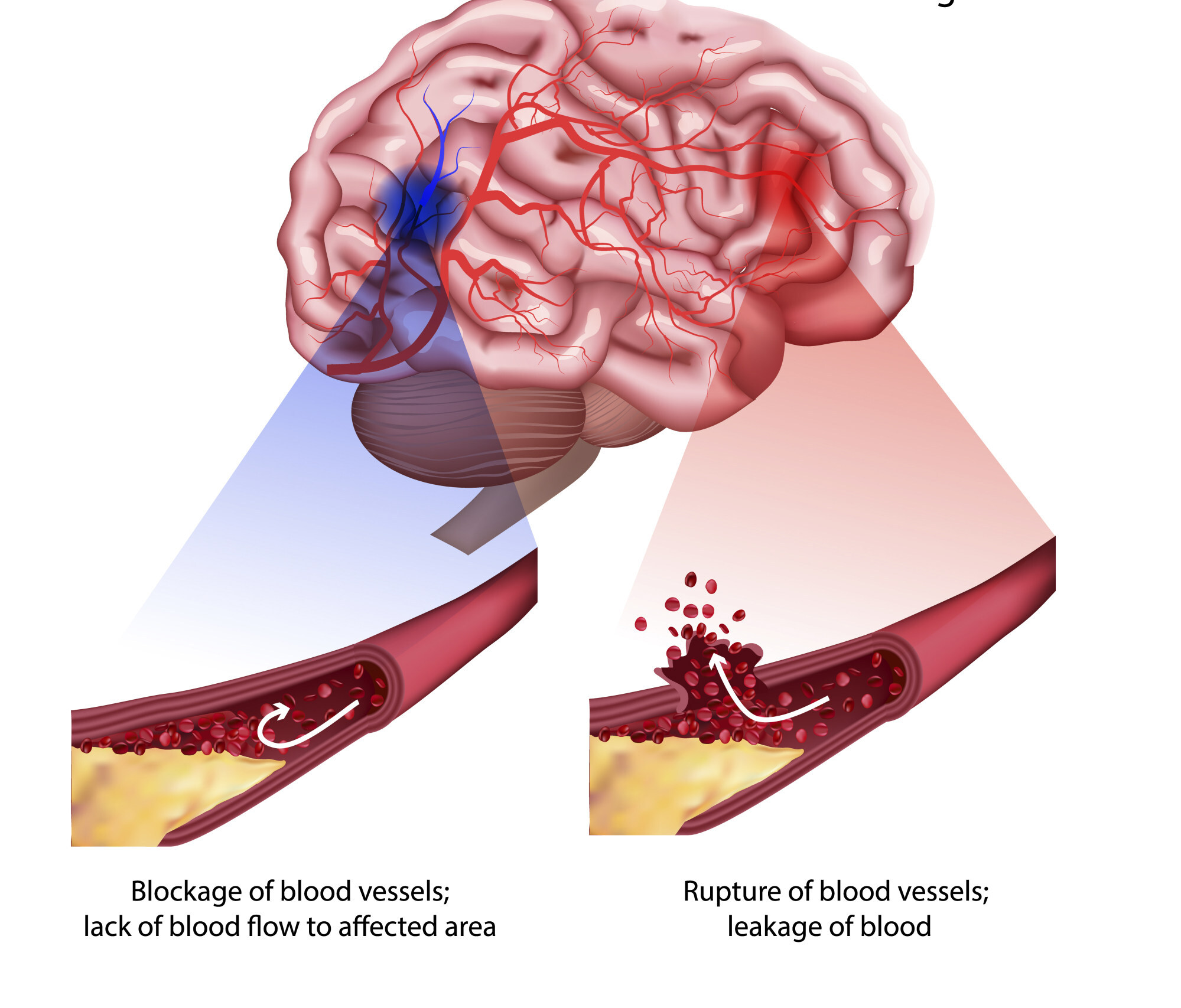 Ischemic stroke. Schlaganfall.