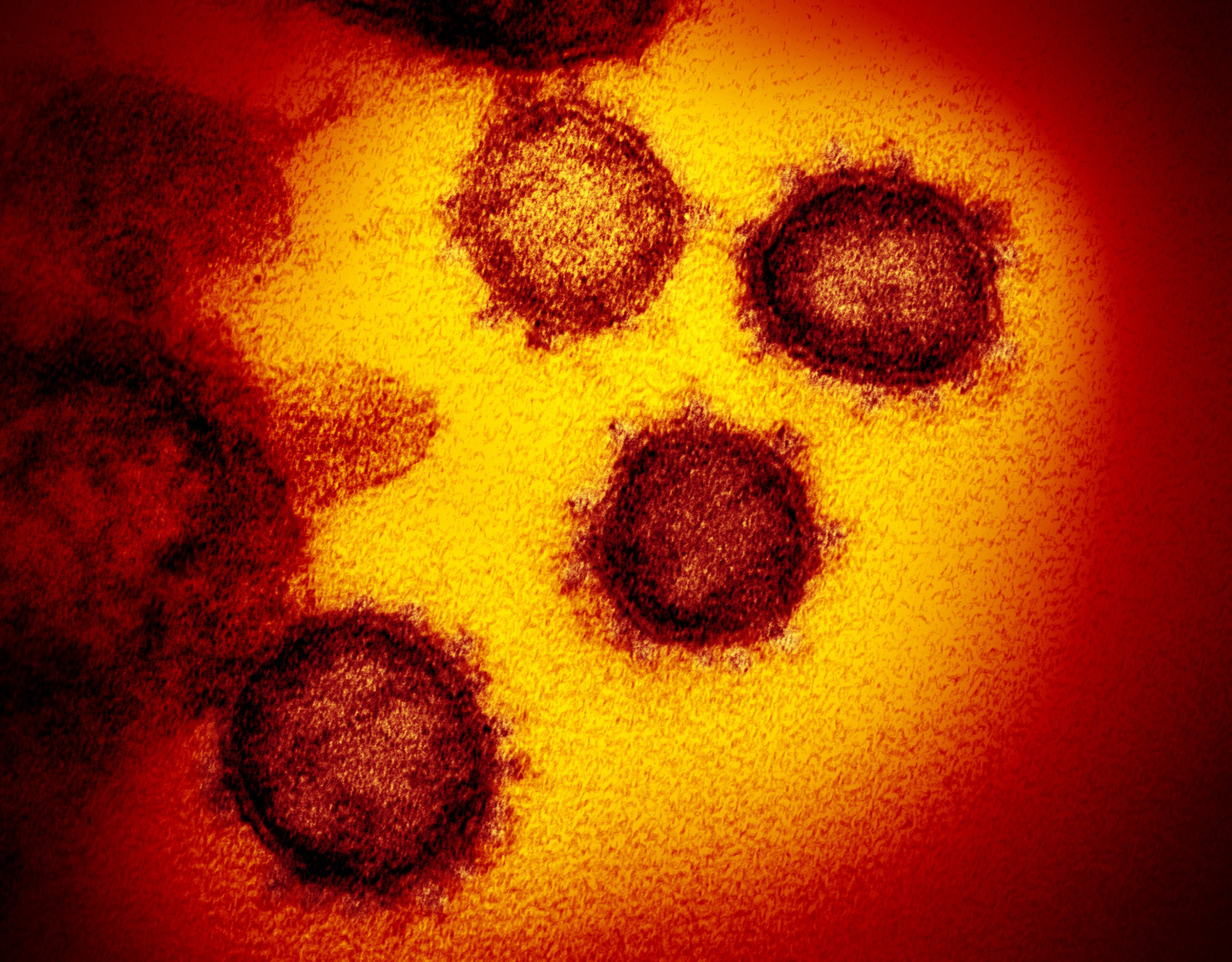 An image from an electron microscope shows SARS-CoV-2, the virus that causes COVID-19. Photo: NIAID-RML/Zuma Press/TNS