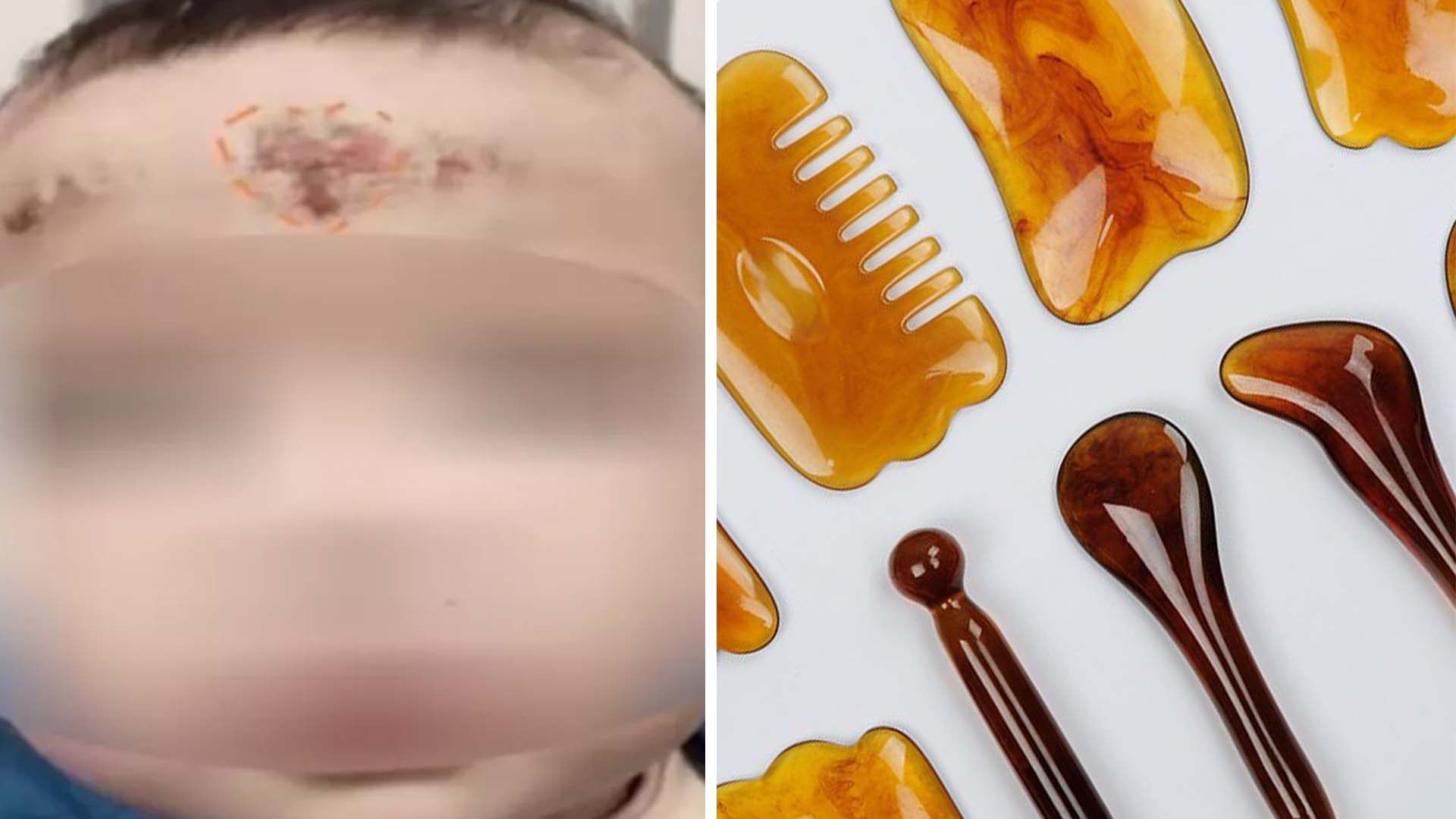 Traditional Chinese medicine treatment by grandma leaves baby girl in hospital  with serious injuries to her face | South China Morning Post