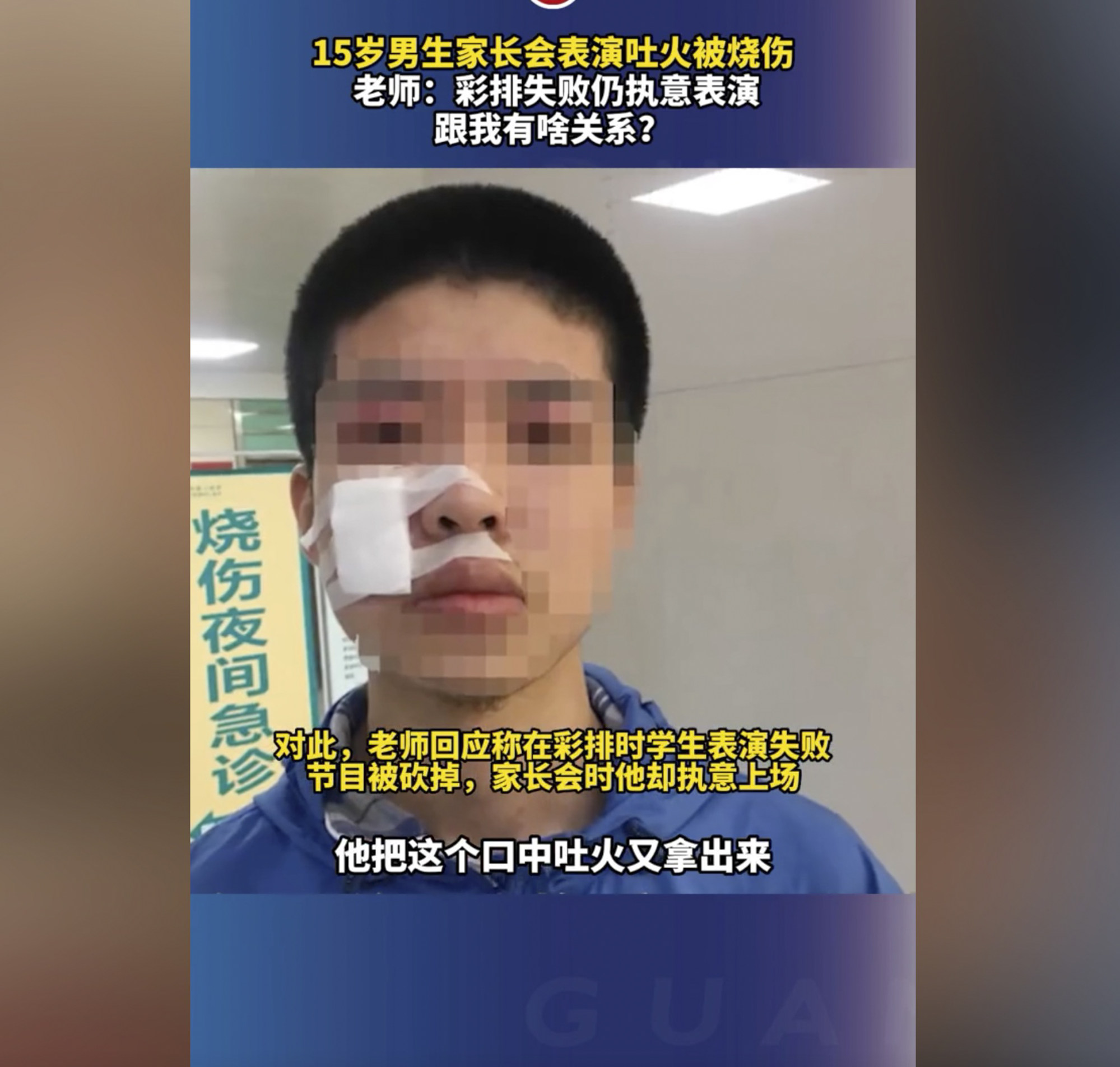 The student had to have cosmetic surgery after his fire breathing stunt. Photo: Douyin