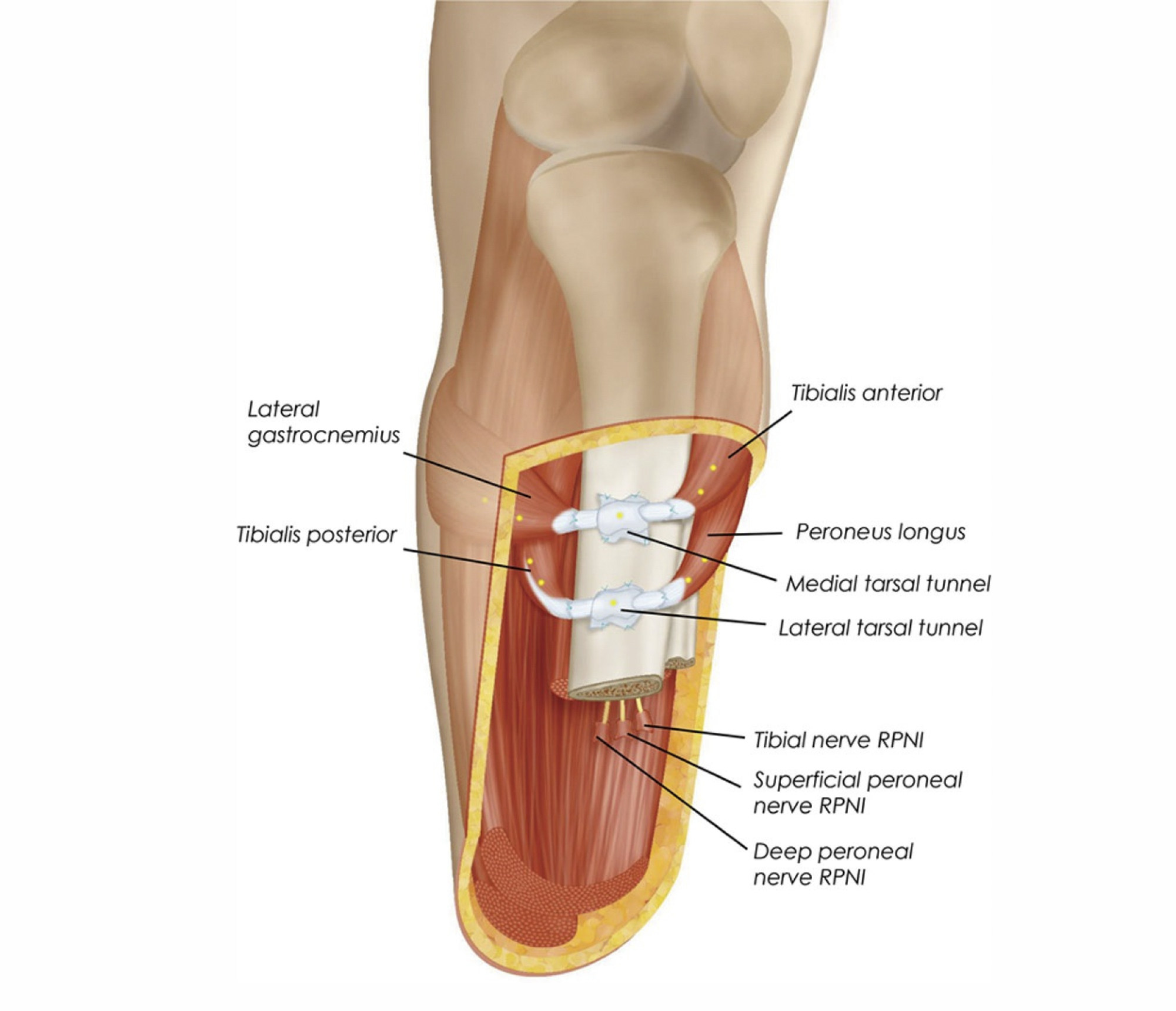 A schematic illustration of the Ewing Amputation. Photo: The Ewing Amputation
