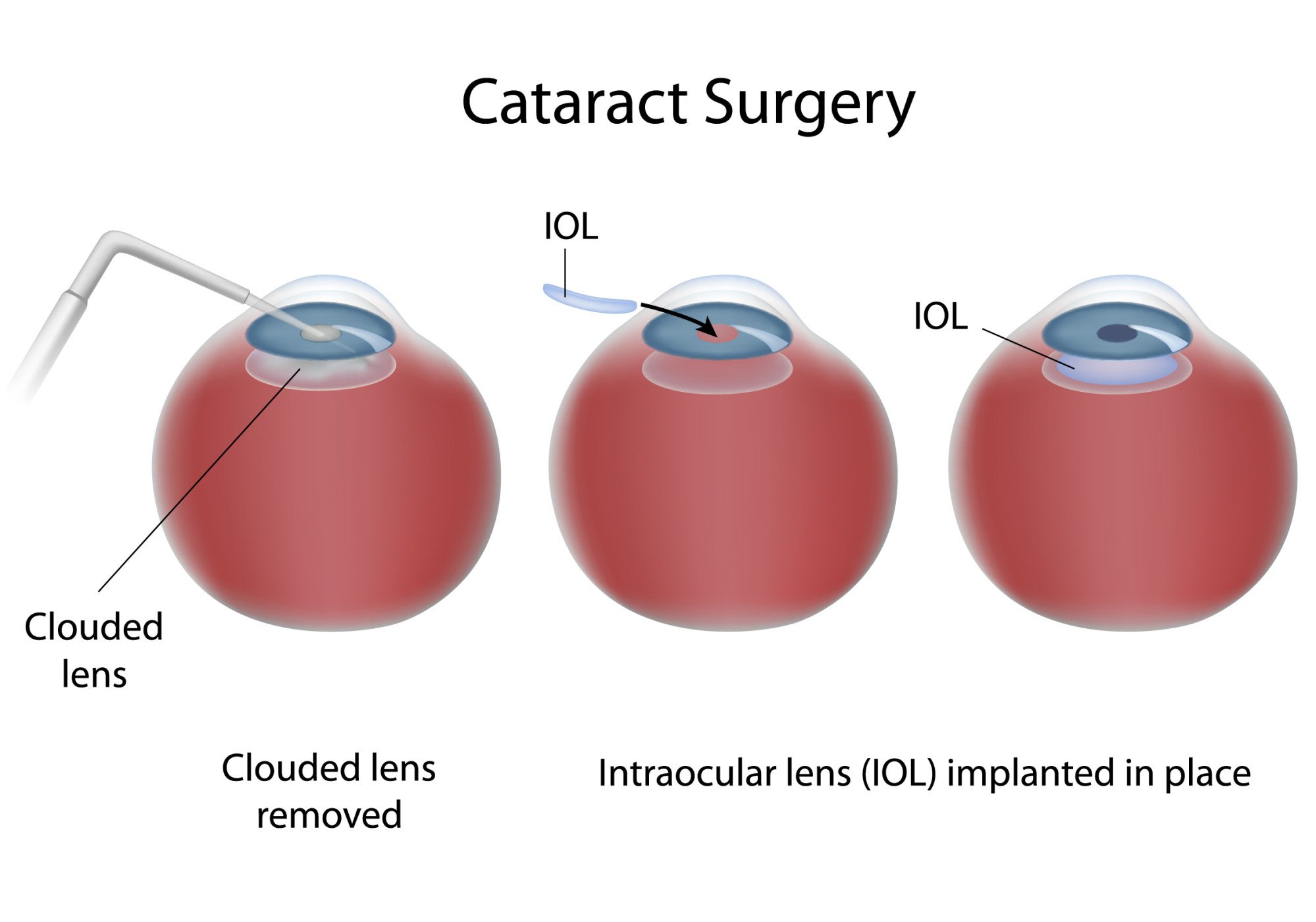 Cataract surgery involves the removal and replacement of a clouded lens. Illustration: Shutterstock