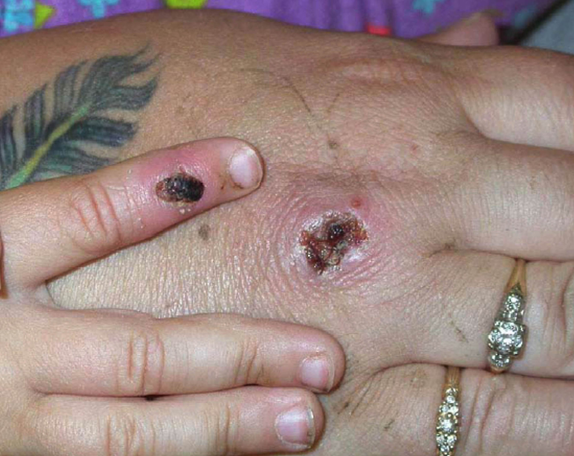 Symptoms of monkeypox on a patient’s hand at the Centres for Disease Control and Prevention. Photo: Getty Images