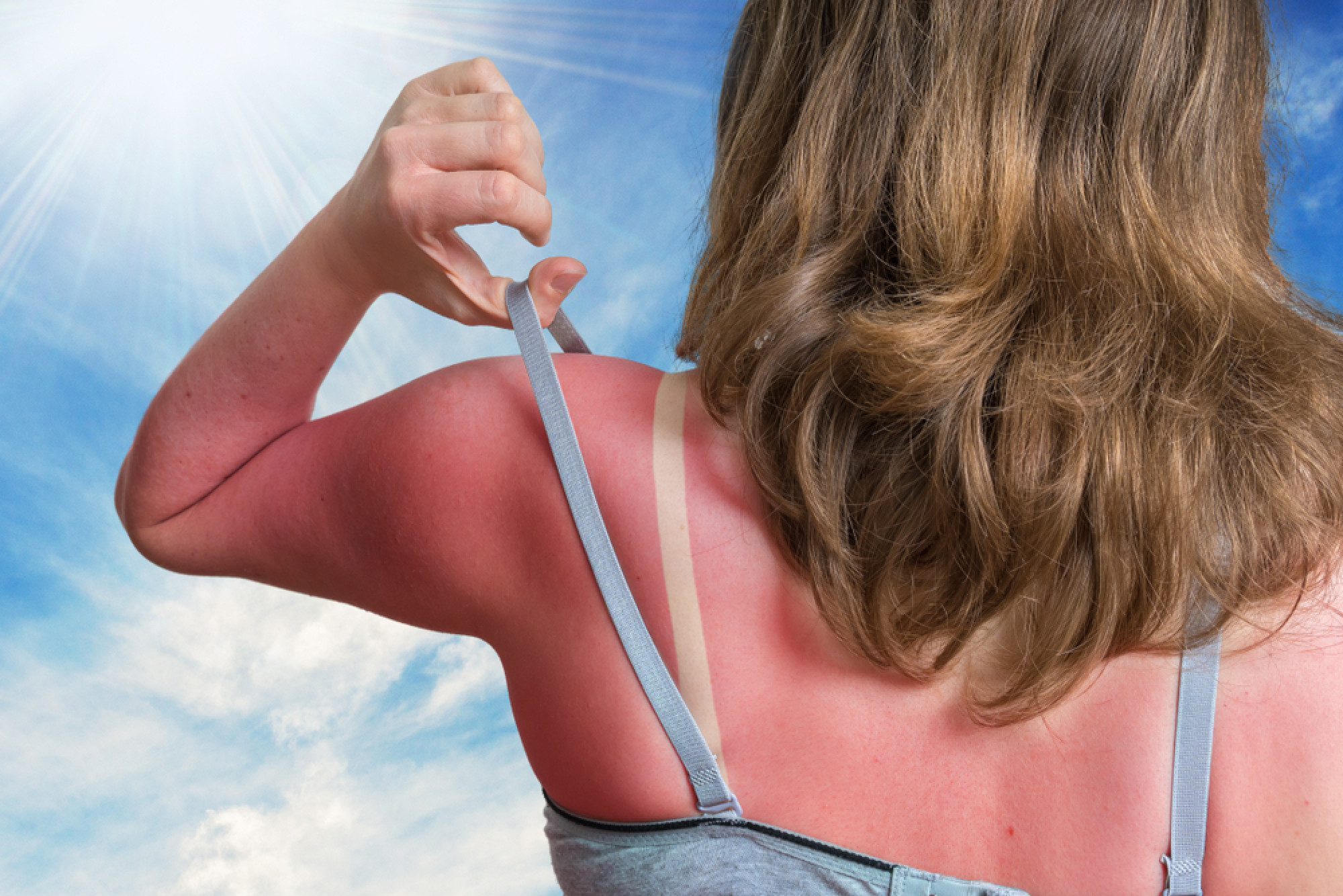 It is important to put sunscreen on all areas of exposed skin when outside in the sun to avoid getting sunburn. Photo: Shutterstock