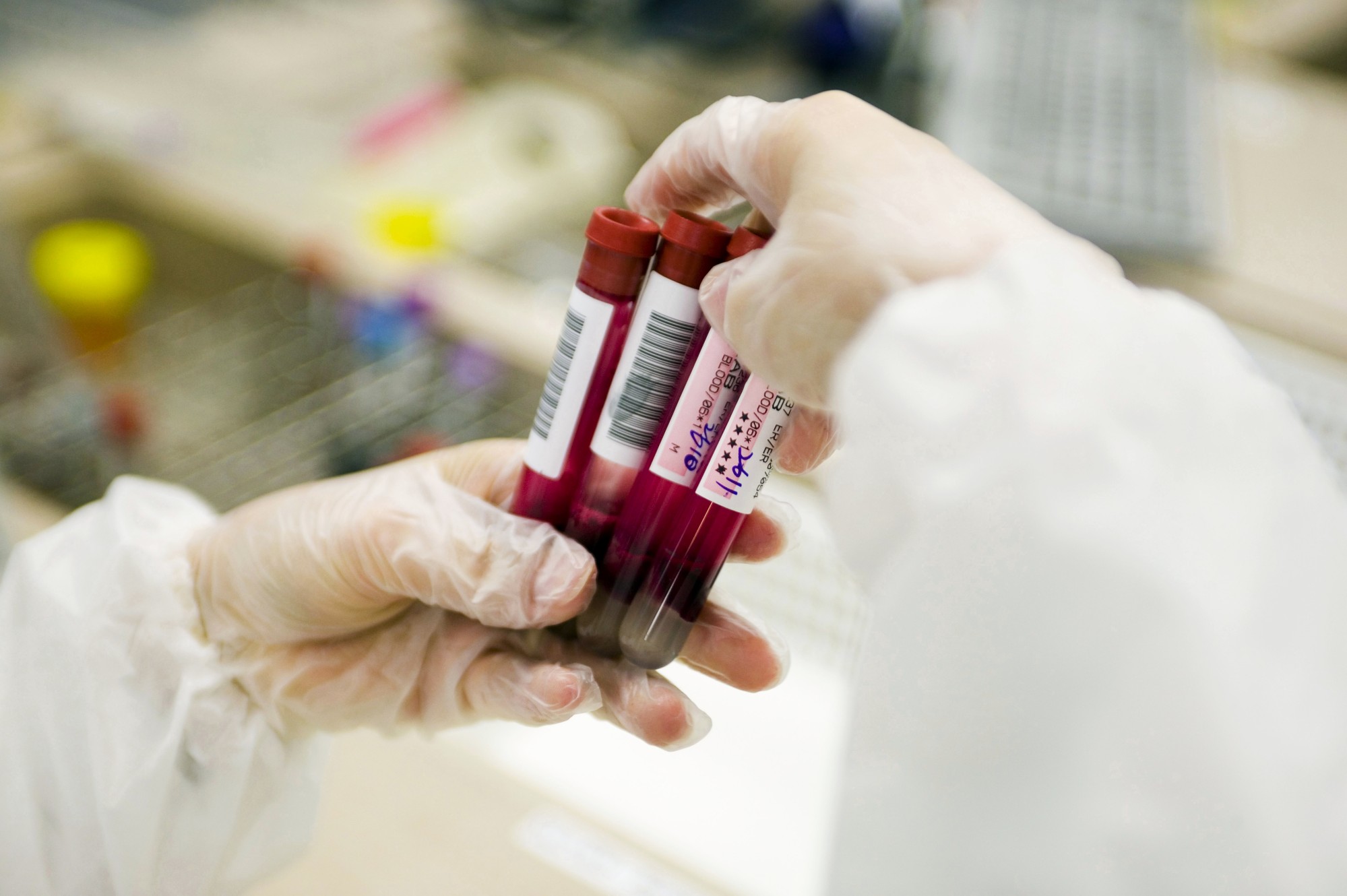 A blood test being trialled by Britain’s National Health Service aims to spot more than 50 kinds of cancers in people without symptoms. Photo: Getty Images