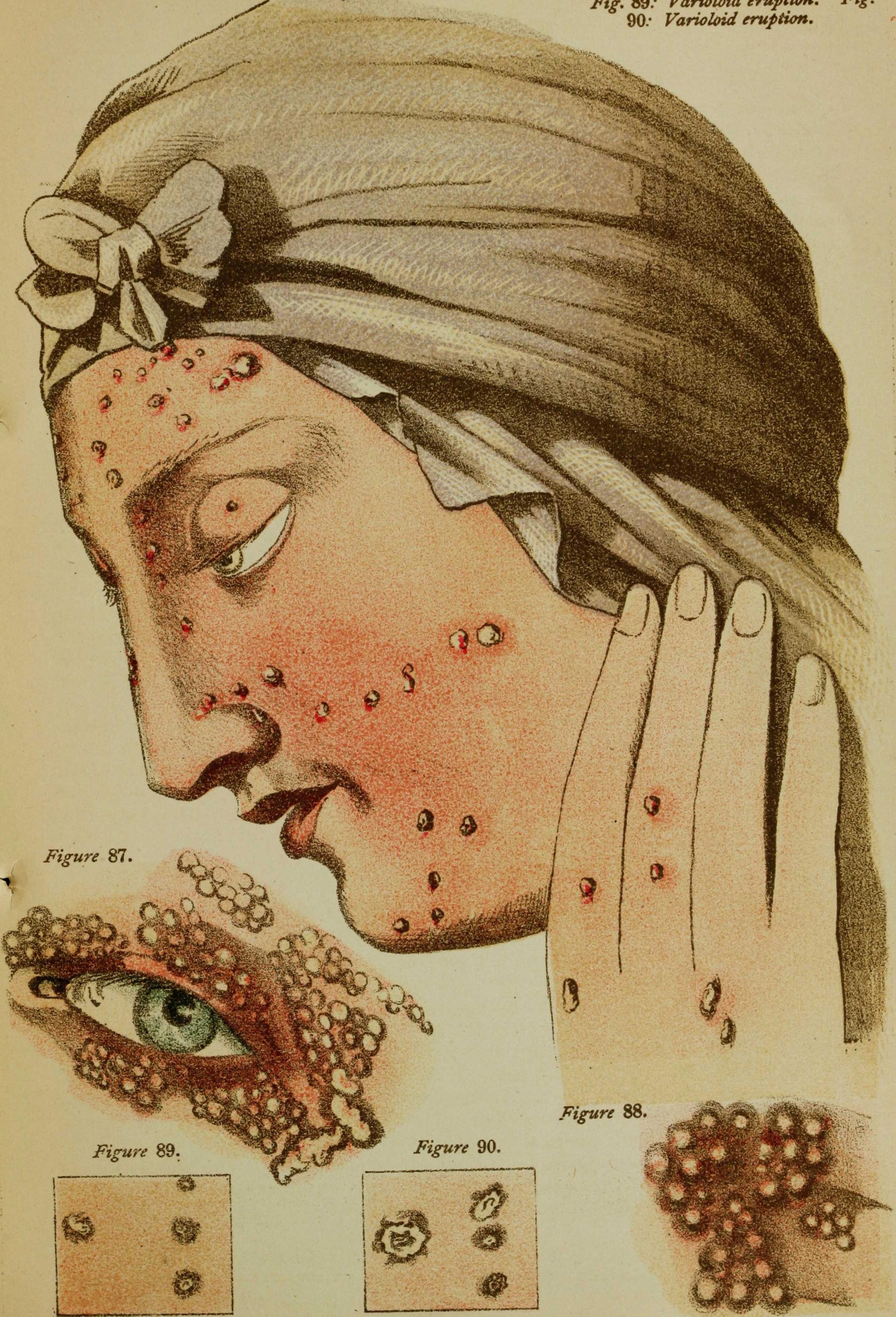 An illustration depicting smallpox pustules on the face and hand of a woman. Photo: Smith Collection/Gado/Getty Images