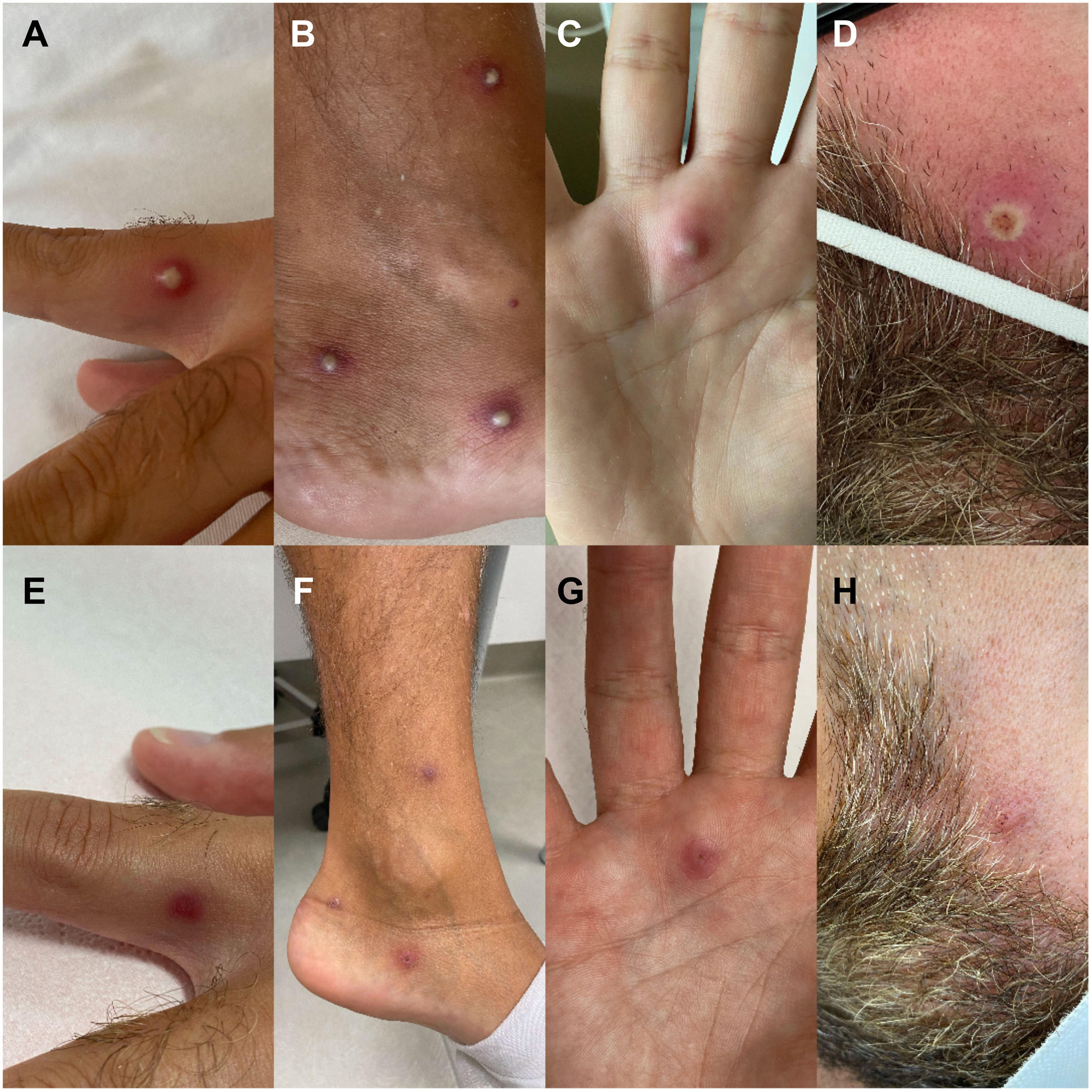 The patient developed small, painful blisters after first breaking out in a rash. Photos: Journal of Infection