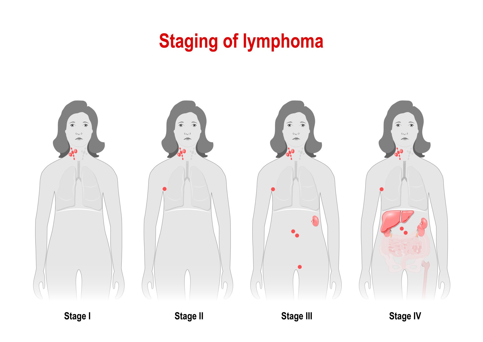 Lymphoma symptoms, treatments for the blood cancer, and who’s most at ...