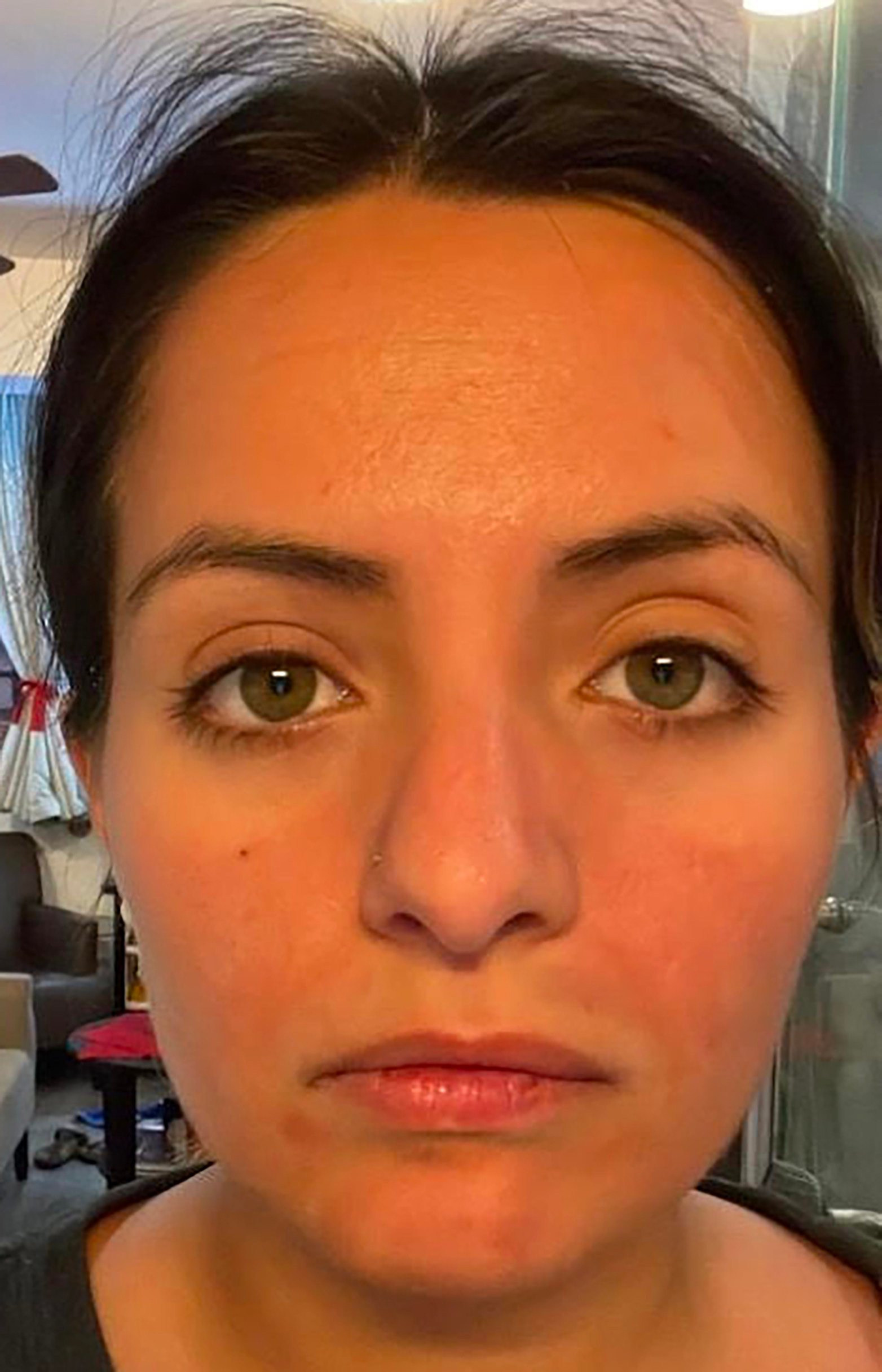 Sarah Vega’s face eight days after her first Hong Kong microneedling experience. Some redness and inflammation is normal but is supposed to subside within 24-48 hours. Photo: Sarah Vega