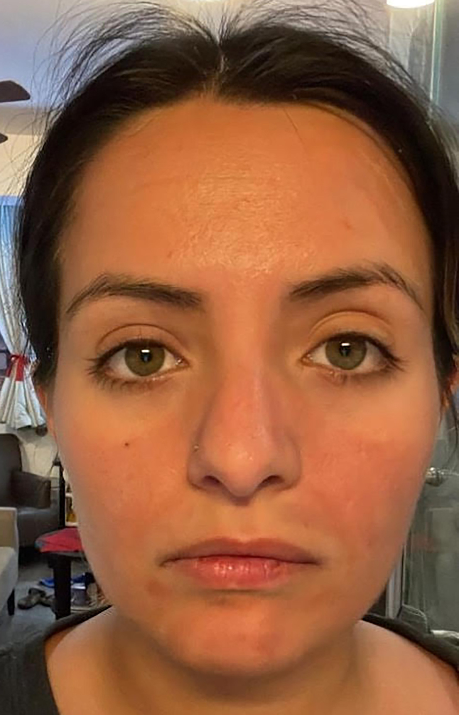 Sarah Vega’s face 8 days after her first Hong Kong microneedling experience. Redness and inflammation is supposed to subside within 24-48 hours. Photo: Sarah Vega