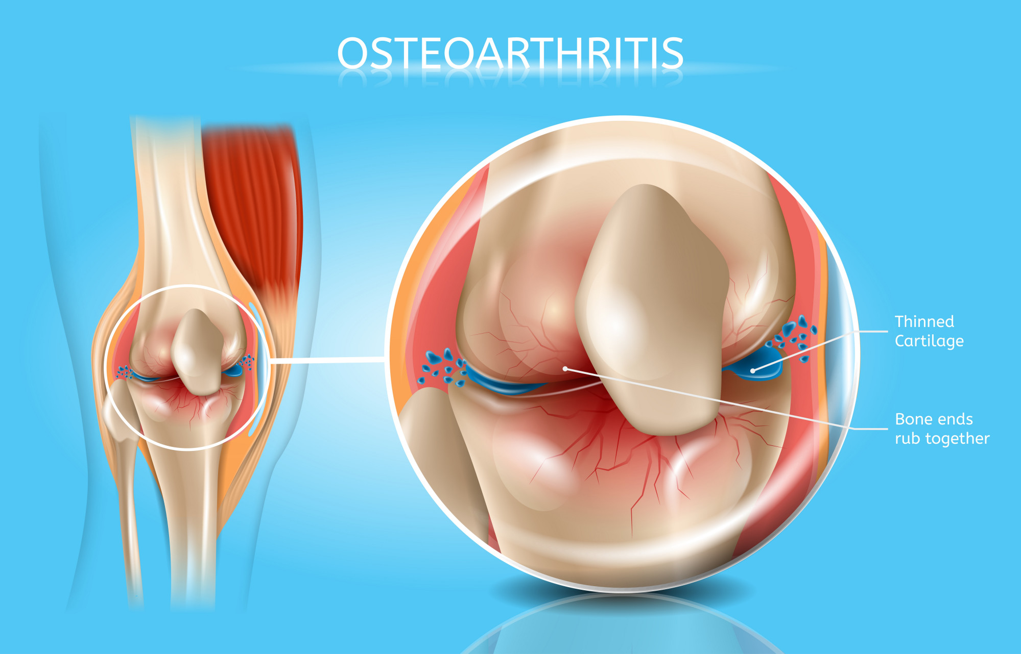 When cartilage becomes thinner and bones rub together, the pain and swelling are known as osteoarthritis. Illustration: Shutterstock