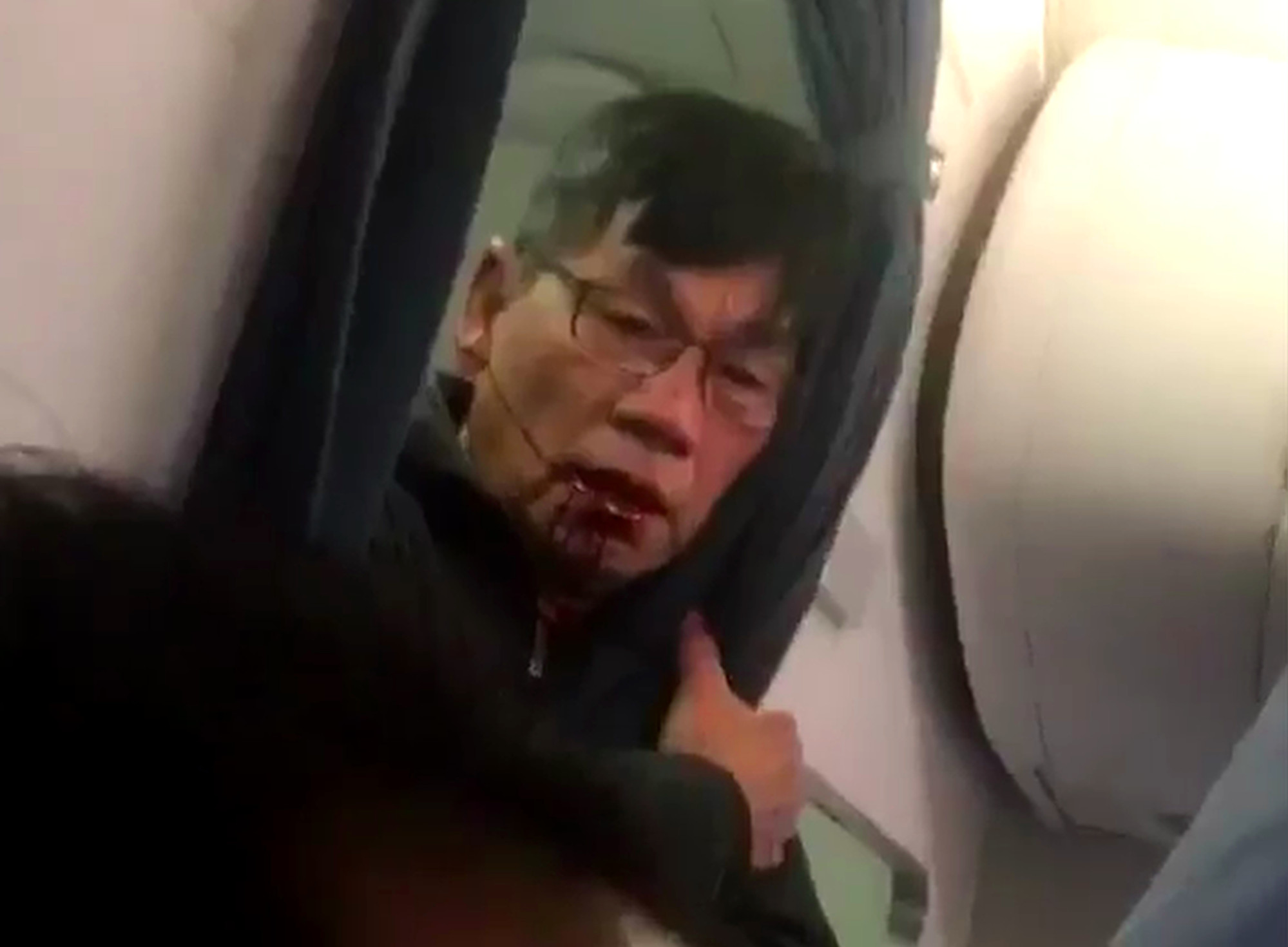 David Dao suffered a concussion, broken nose and lost two teeth while being forcibly removed from an overbooked flight in 2017. Photo: Facebook