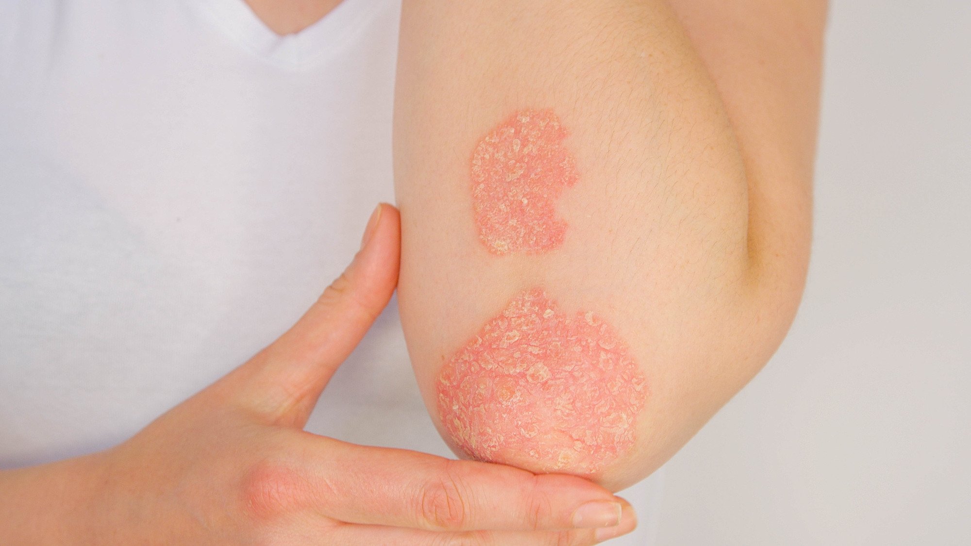 How To Tell The Difference Between Eczema And Psoriasis So You Can Get The Right Treatment