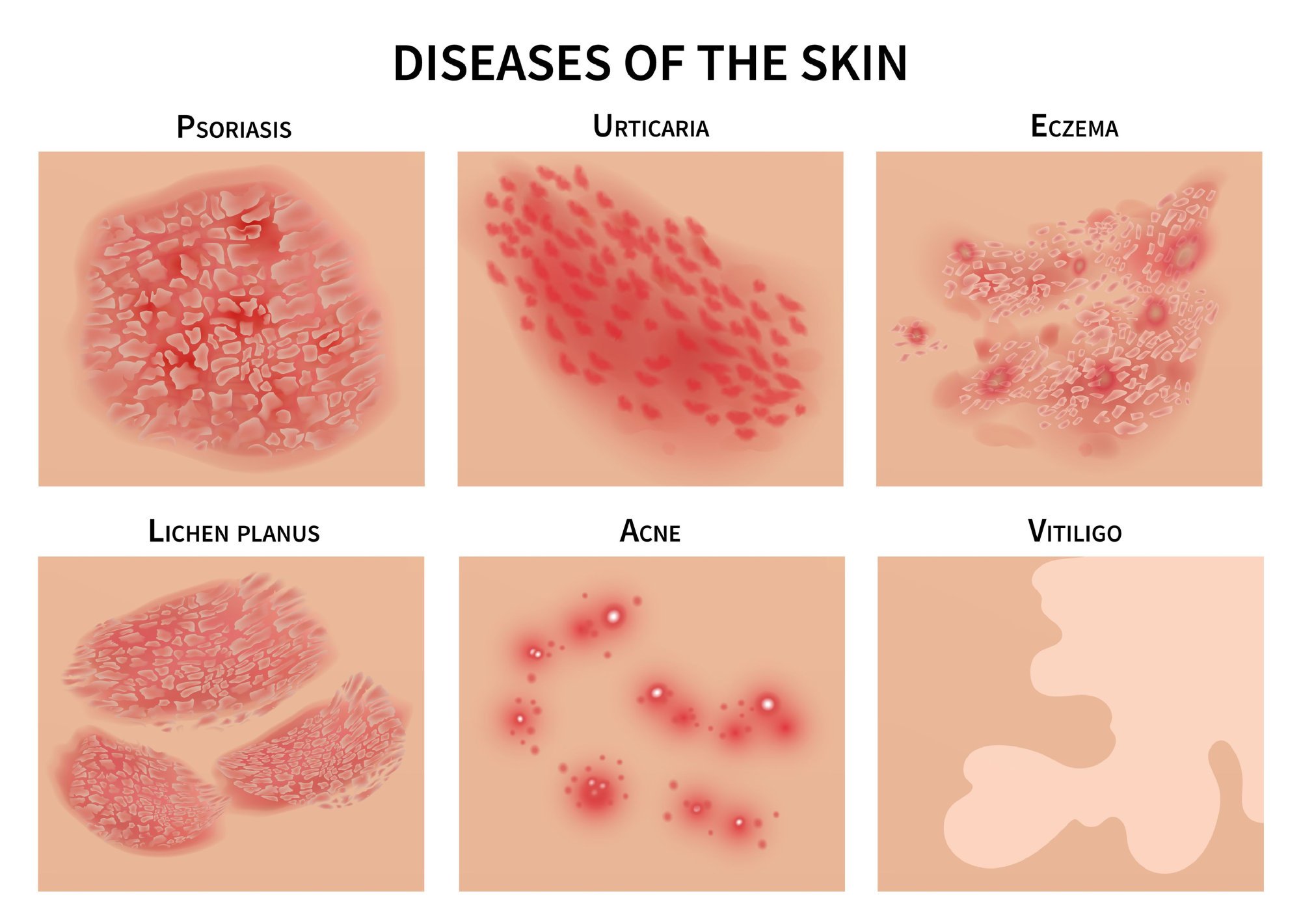 how-to-tell-the-difference-between-eczema-and-psoriasis-so-you-can-get