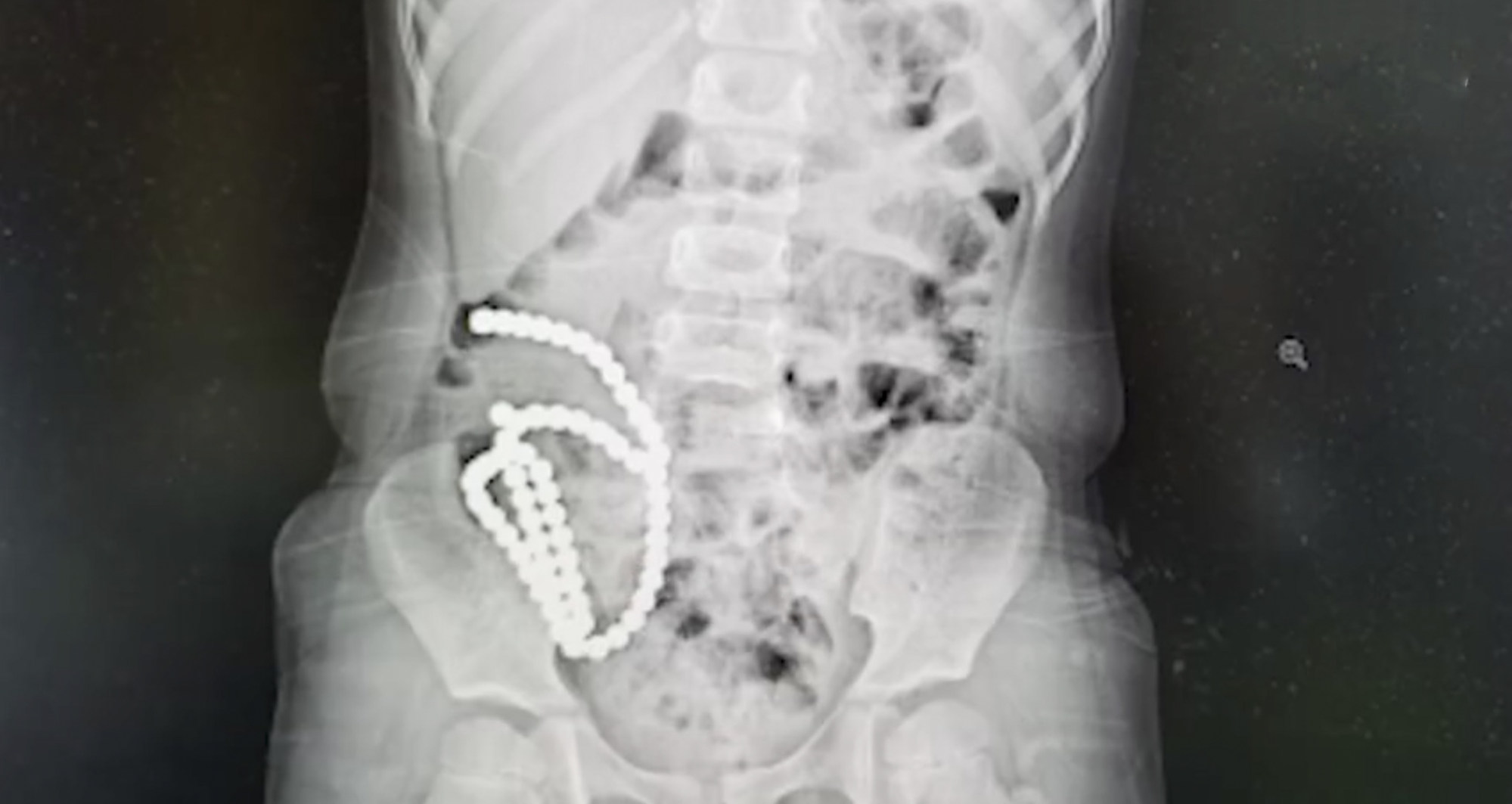 Toy beads puncture girl's intestine: Chinese surgeons remove 61 magnetic  beads from tummy of child, 4, after she swallowed the lot