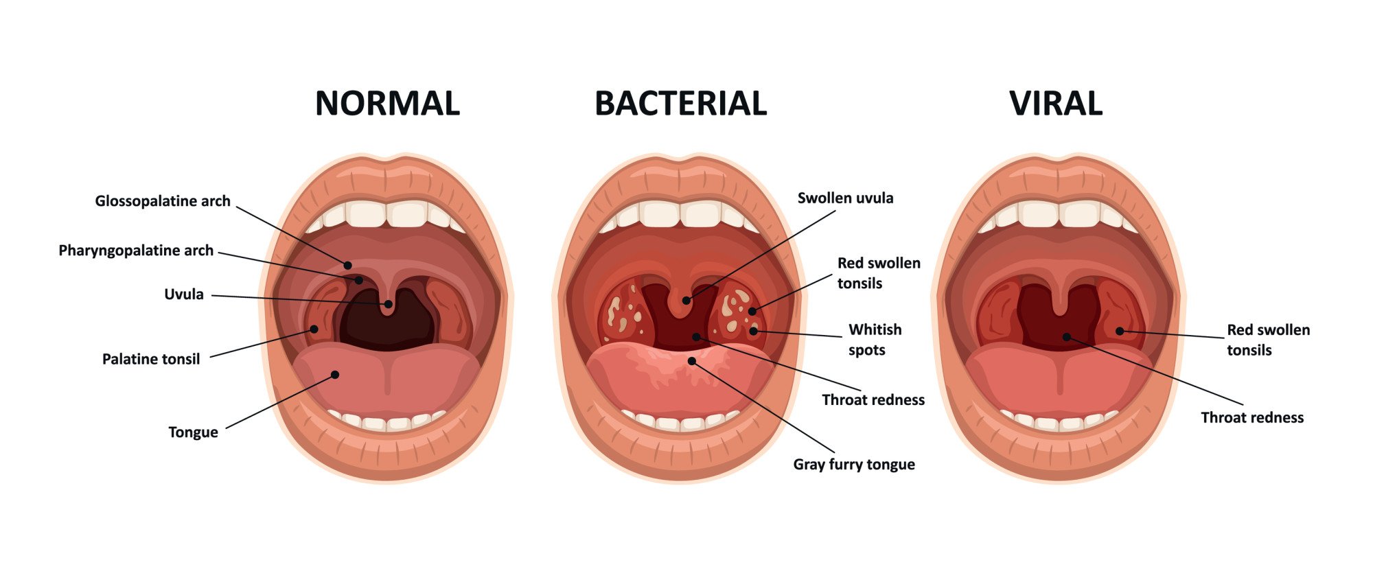 strep throat vs sore throat