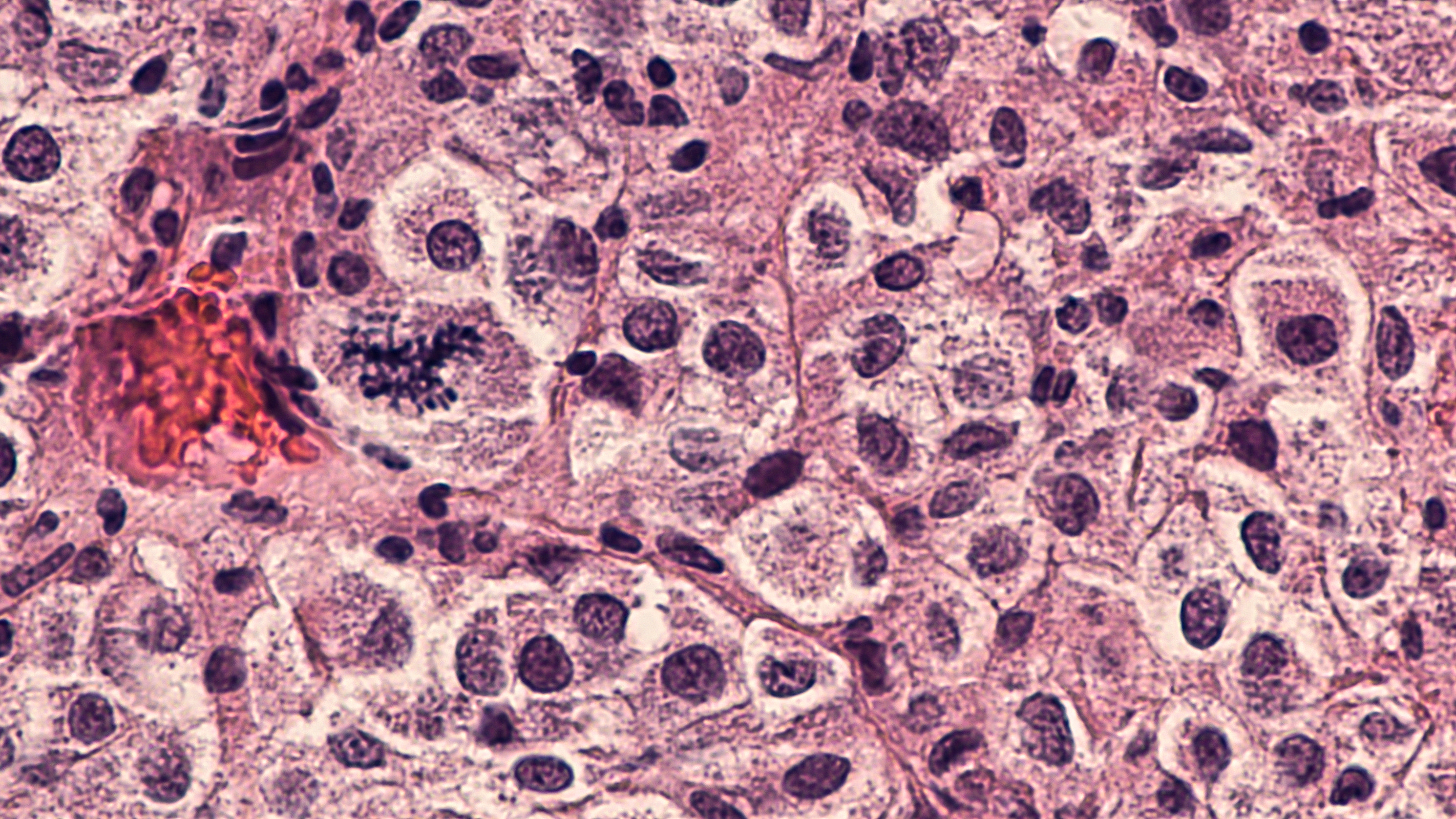 Data from Moderna and Merck skin cancer Phase 2 trials shows an “extremely strong result” for a personalised cancer vaccine. Photo: Shutterstock Images