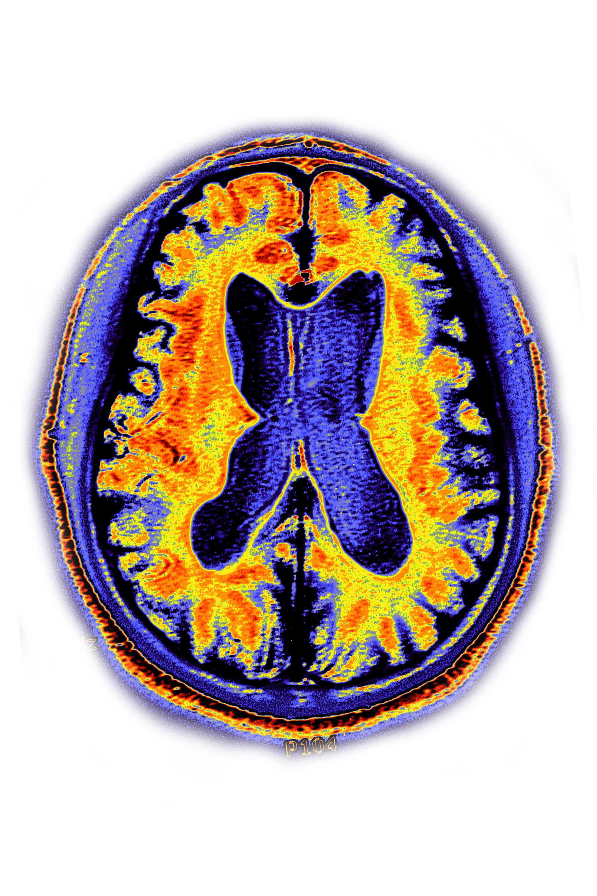 why-should-you-have-a-brain-scan-to-test-for-dementia-when-there-s-no