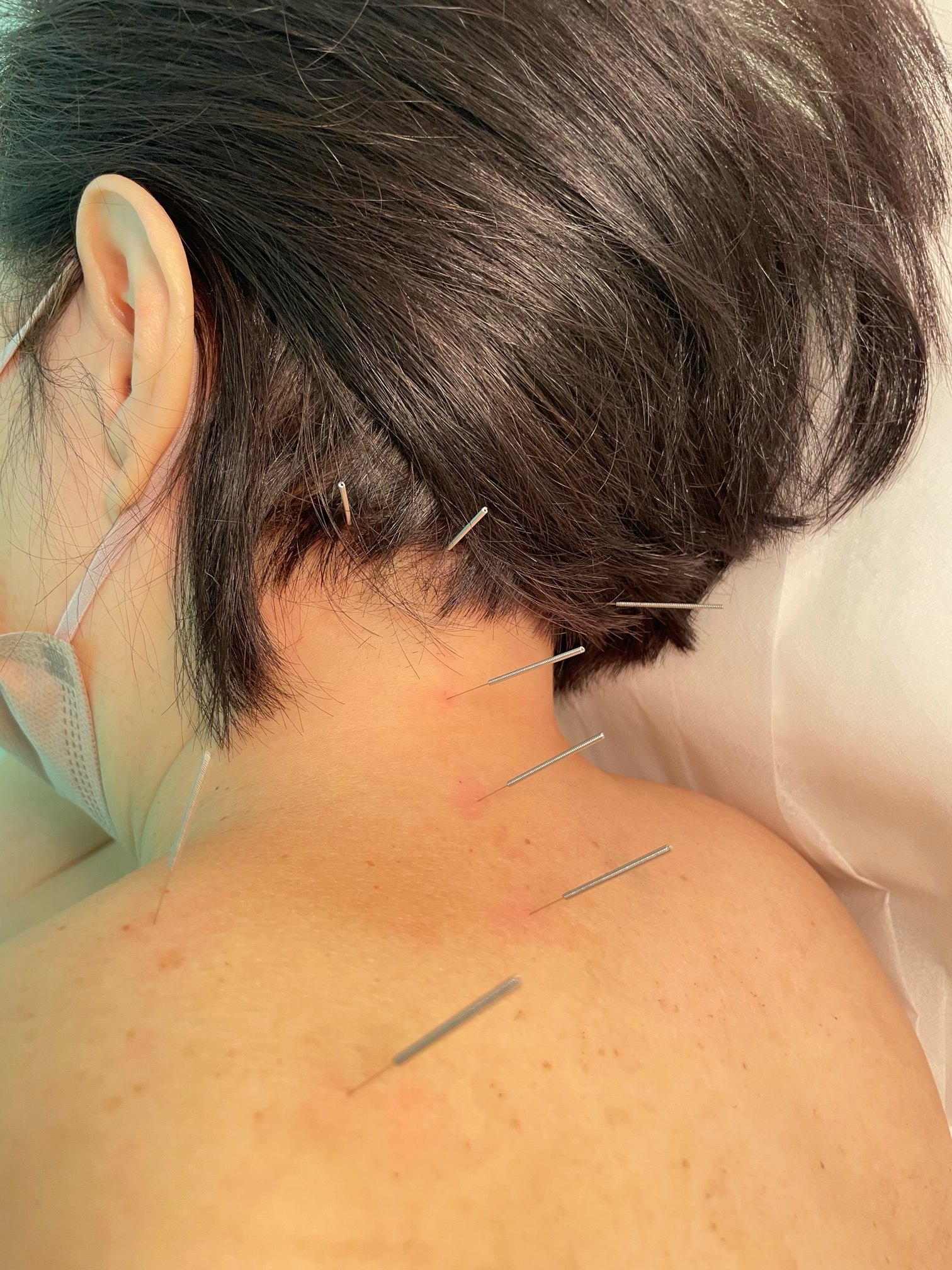 A patient receiving acupuncture treatment for headaches. It is one of the techniques traditional Chinese medicine practitioners use to treat people who have migraines. Photo: Samuel To