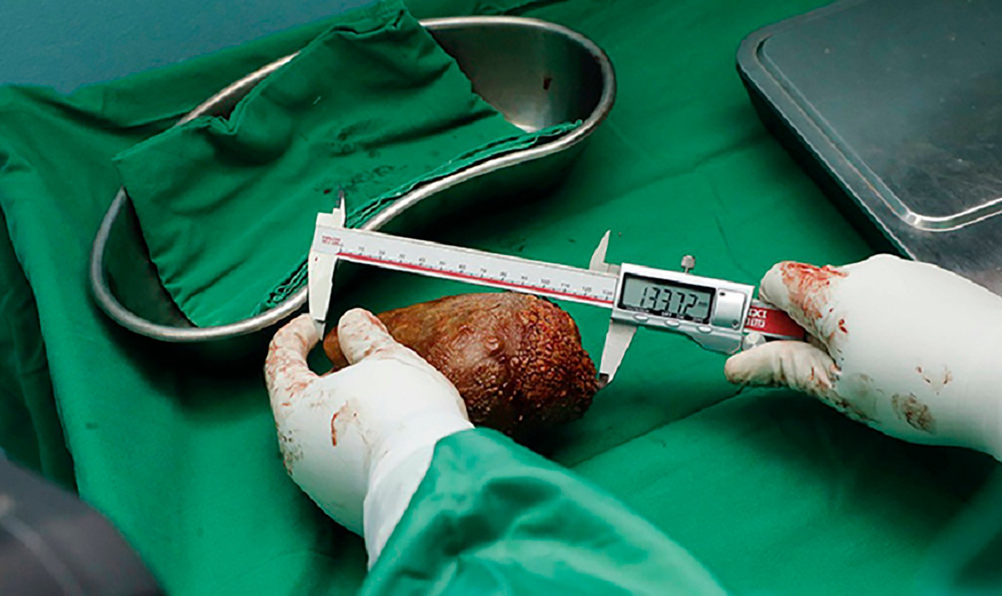 Military doctors in Colombo have removed what has been recorded as the world’s largest kidney stone from a retired soldier. It was 13.37cm long, compared to the average kidney, which is about 10-12cm long. Photo: Sri Lanka Army