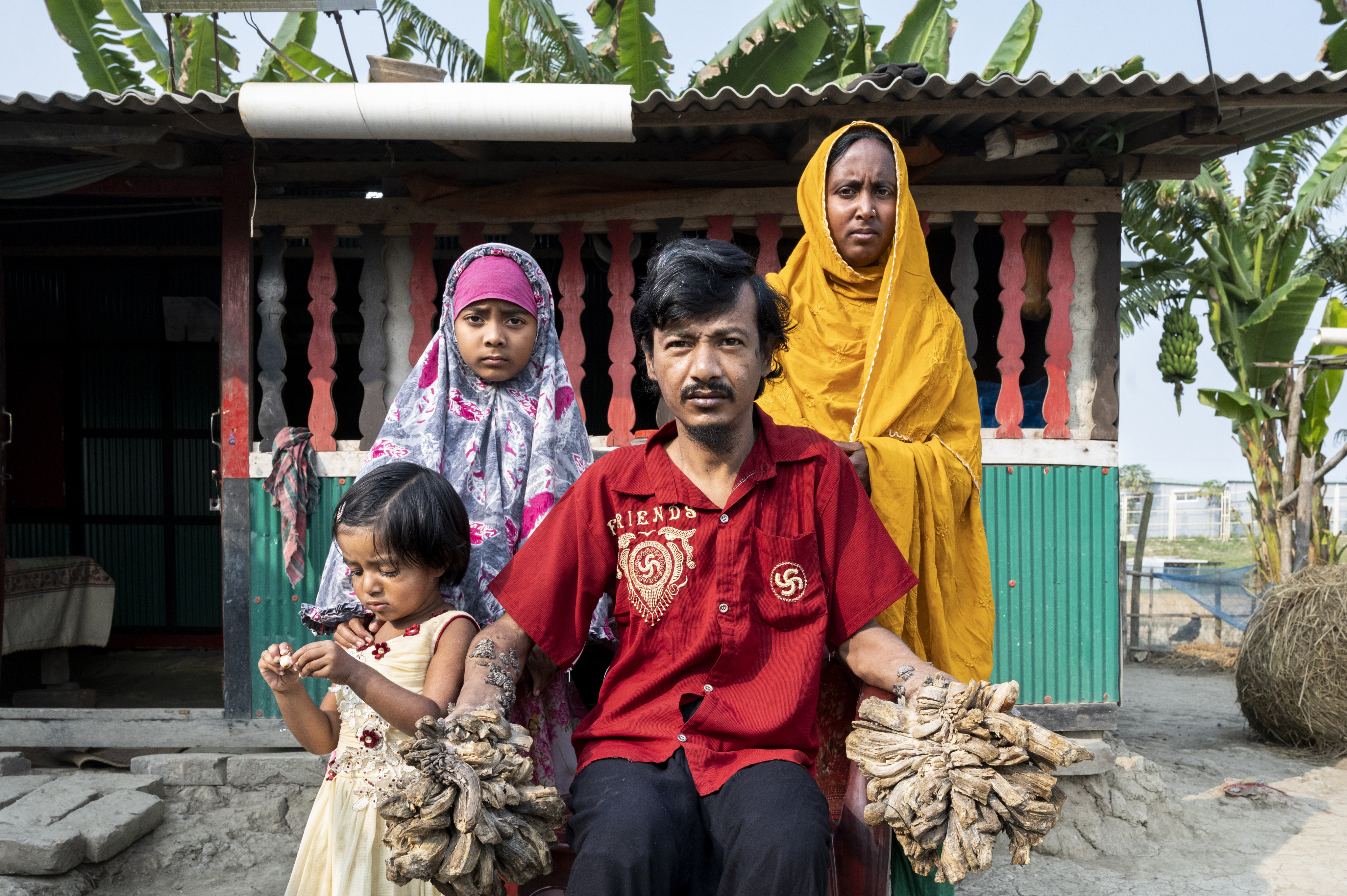 Portrait of Abul Bajandar, his wife Alhima Khauton and two daughters, Bangladesh, 2023. Abul Bajandar know as “Treeman”  - gigantic warts cover his hands and feet, huge protuberances with the texture of tree bark growing especially big around fingers and toes, but also in the arms and legs. These are an extremely rare symptom of his extremely rare condition, epidermodysplasia verruciformis. There are less than 10 documented cases worldwide and, since there is no known cure.&#xA;&#xA;Credit: Miguel Candela