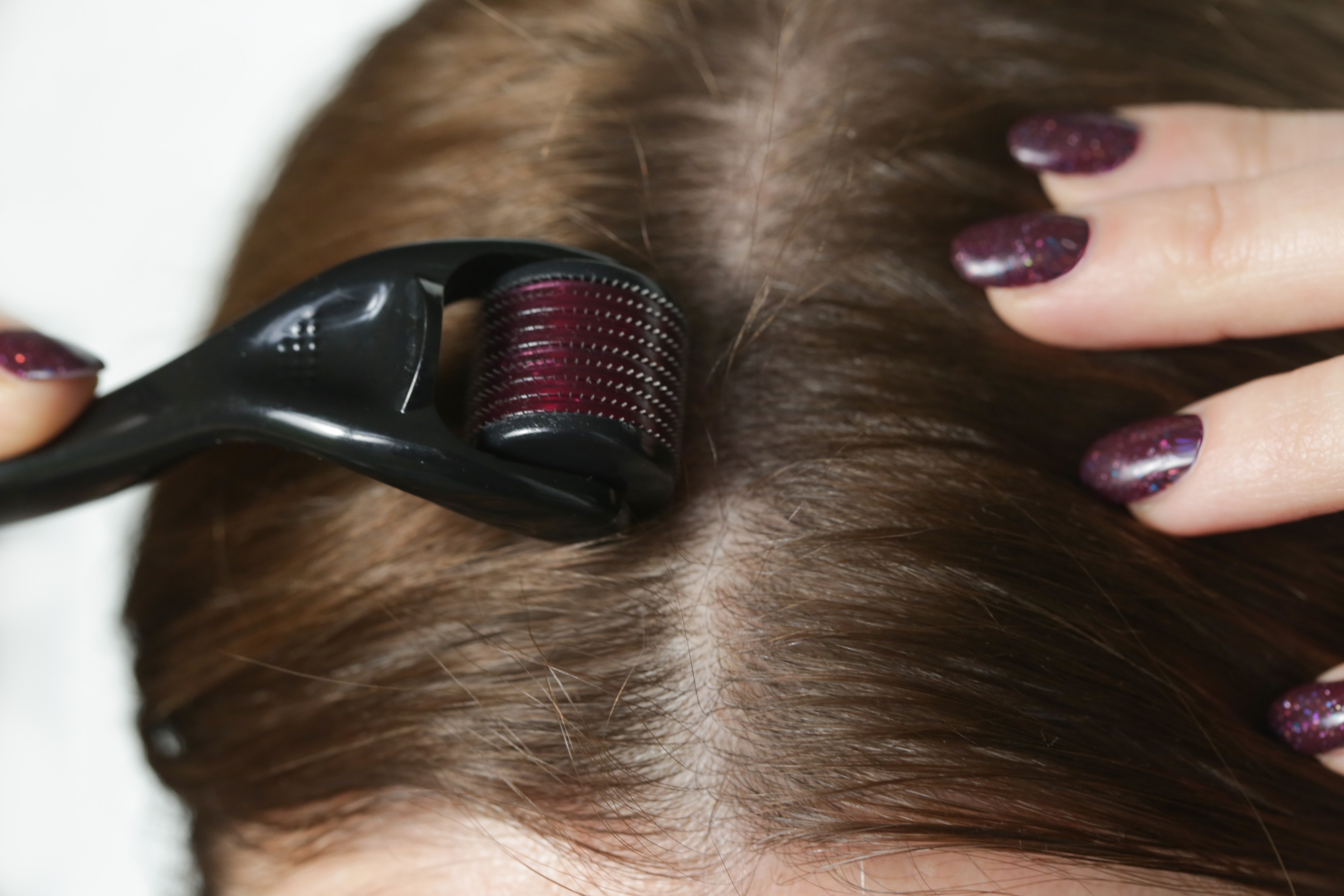 A woman uses a microneedle derma roller to stimulate new hair growth. Photo: Shutterstock