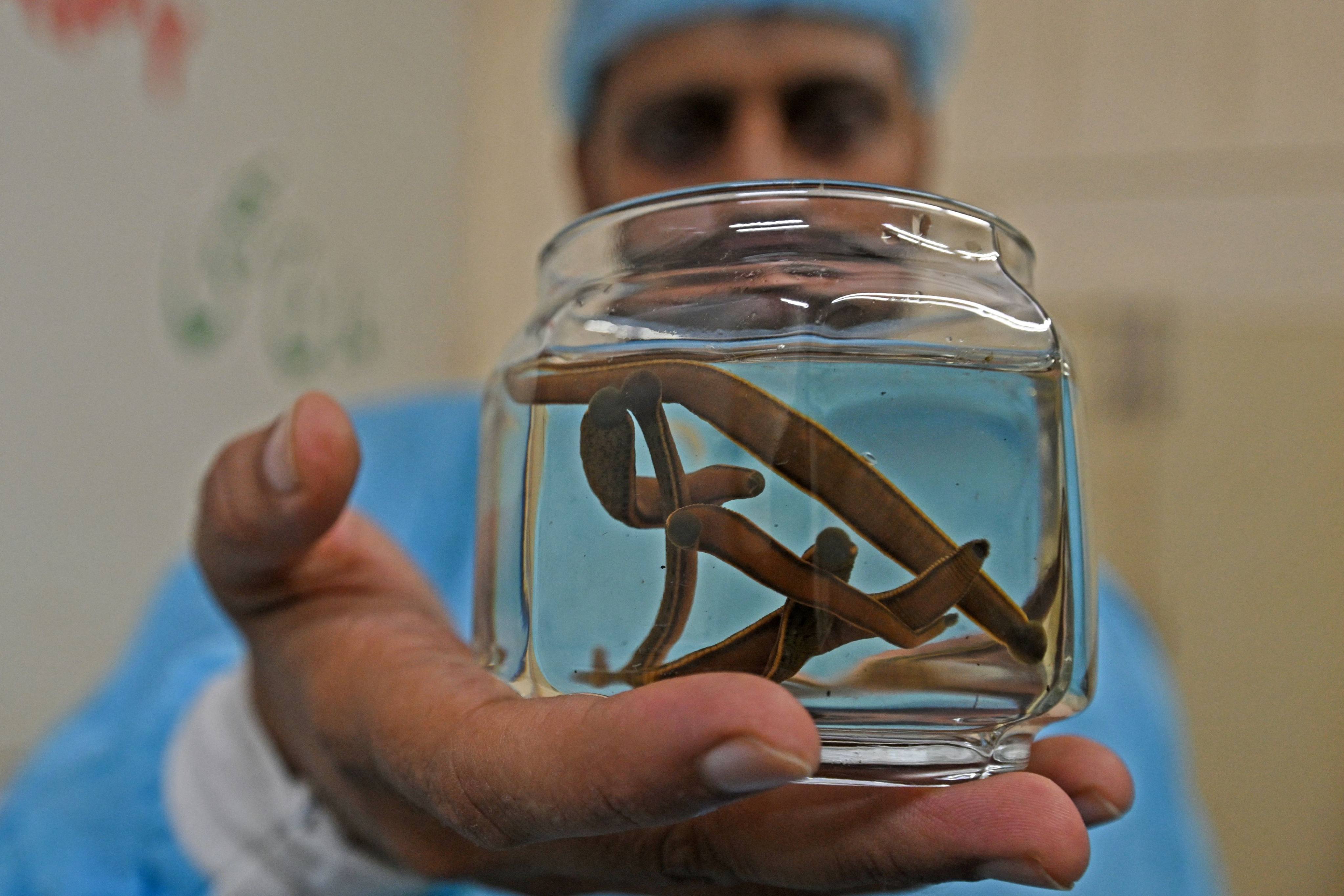 Hakeem Jamaluddin Badai, an ayurvedic doctor shows stored leeches used to perform the ancient cupping and leech therapy at a traditional healthcare centre in New Delhi. Photo: AFP