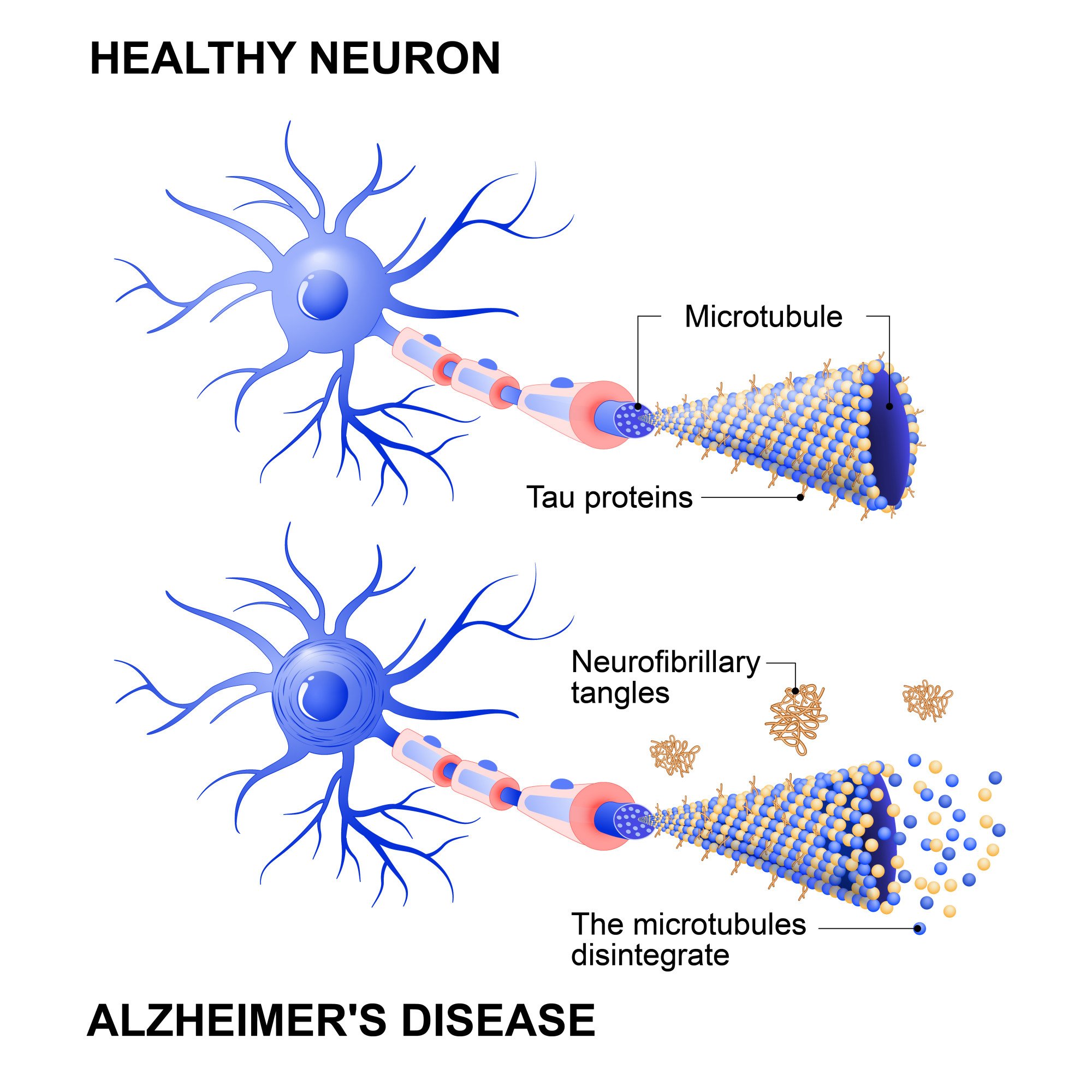 unravelling-2-alzheimer-s-markers-what-are-amyloid-plaques-and-tau