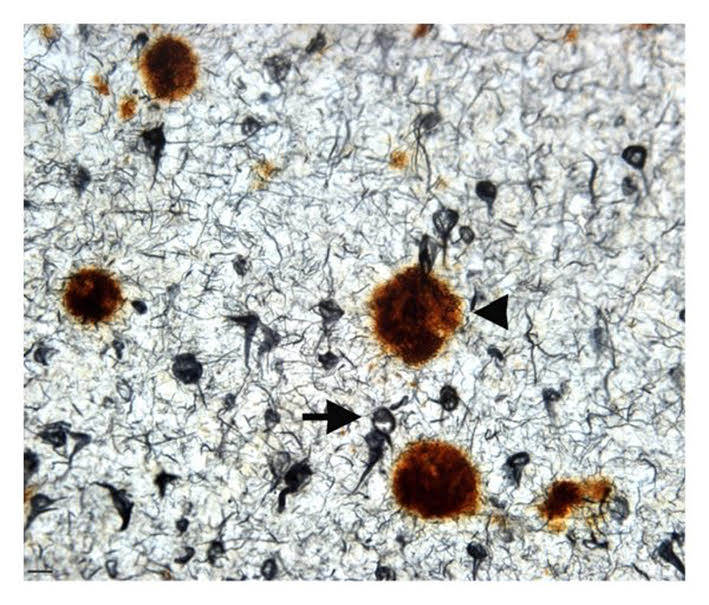 “Sepia galactic storms”: the rust coloured clumps are the stained amyloid plaques, the little black squiggles are the tau tangles. Photo: Andrew Lee