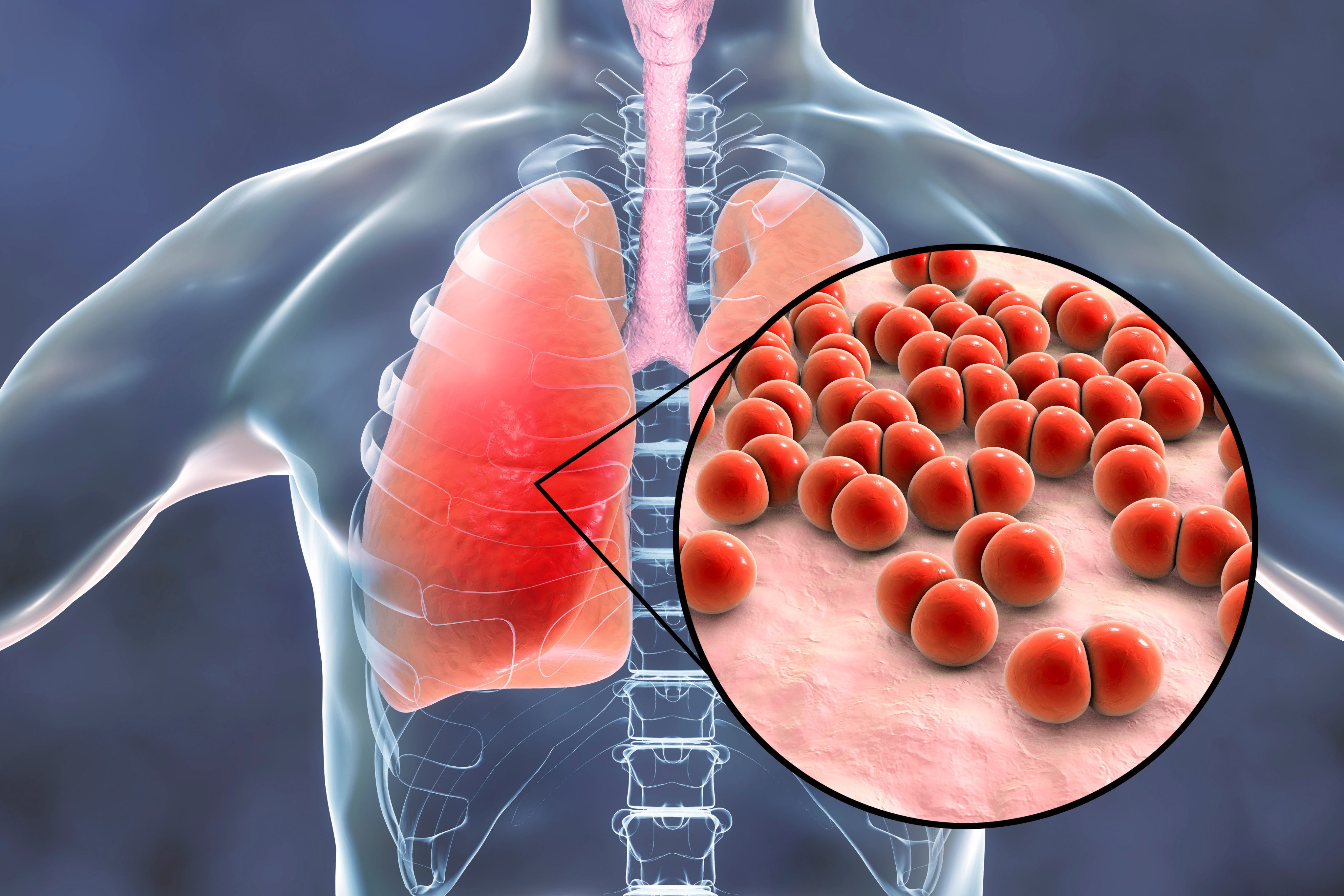 Pneumococcus is a bacteria found in the upper respiratory system and one of the most common causes of pneumonia. Photo: Shutterstock
