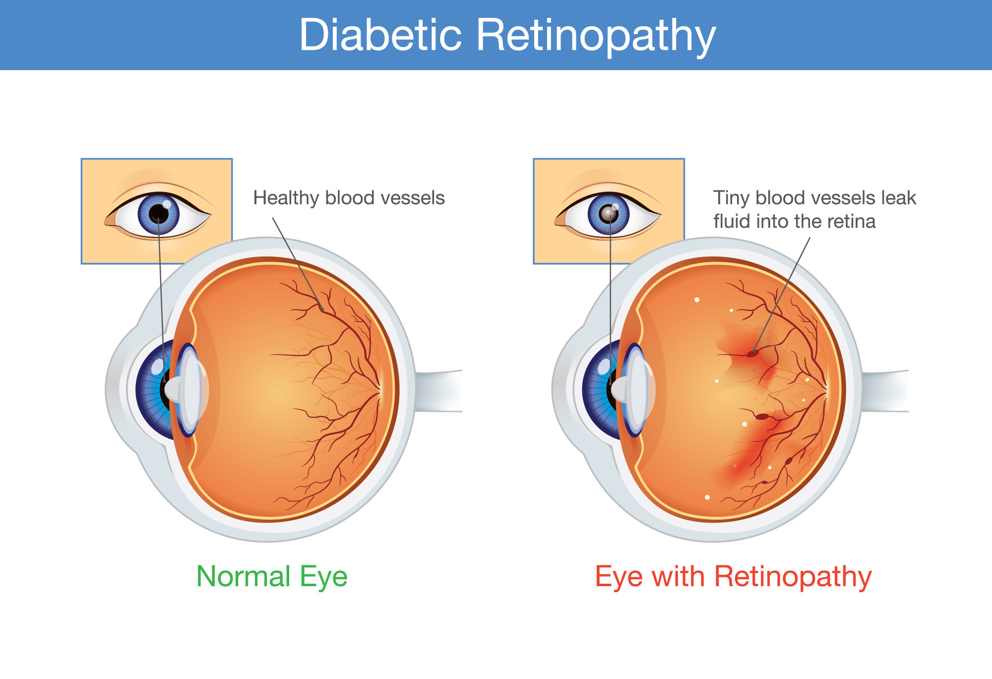 How Diabetes Can Trigger Vision Loss And Blindness 11 Signs Of 