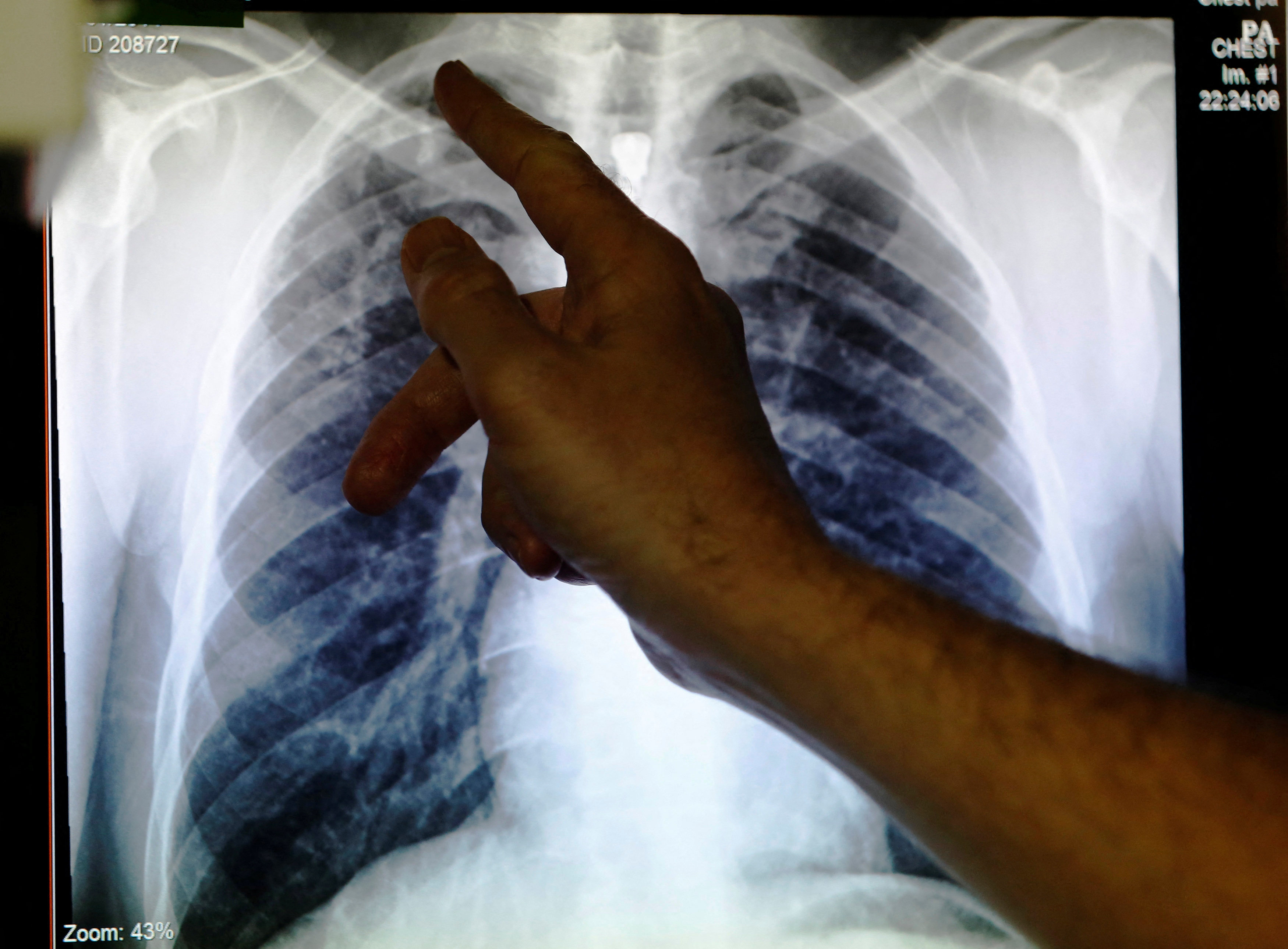 A doctor points to an X-ray showing a pair of lungs infected with tuberculosis. Photo: Reuters