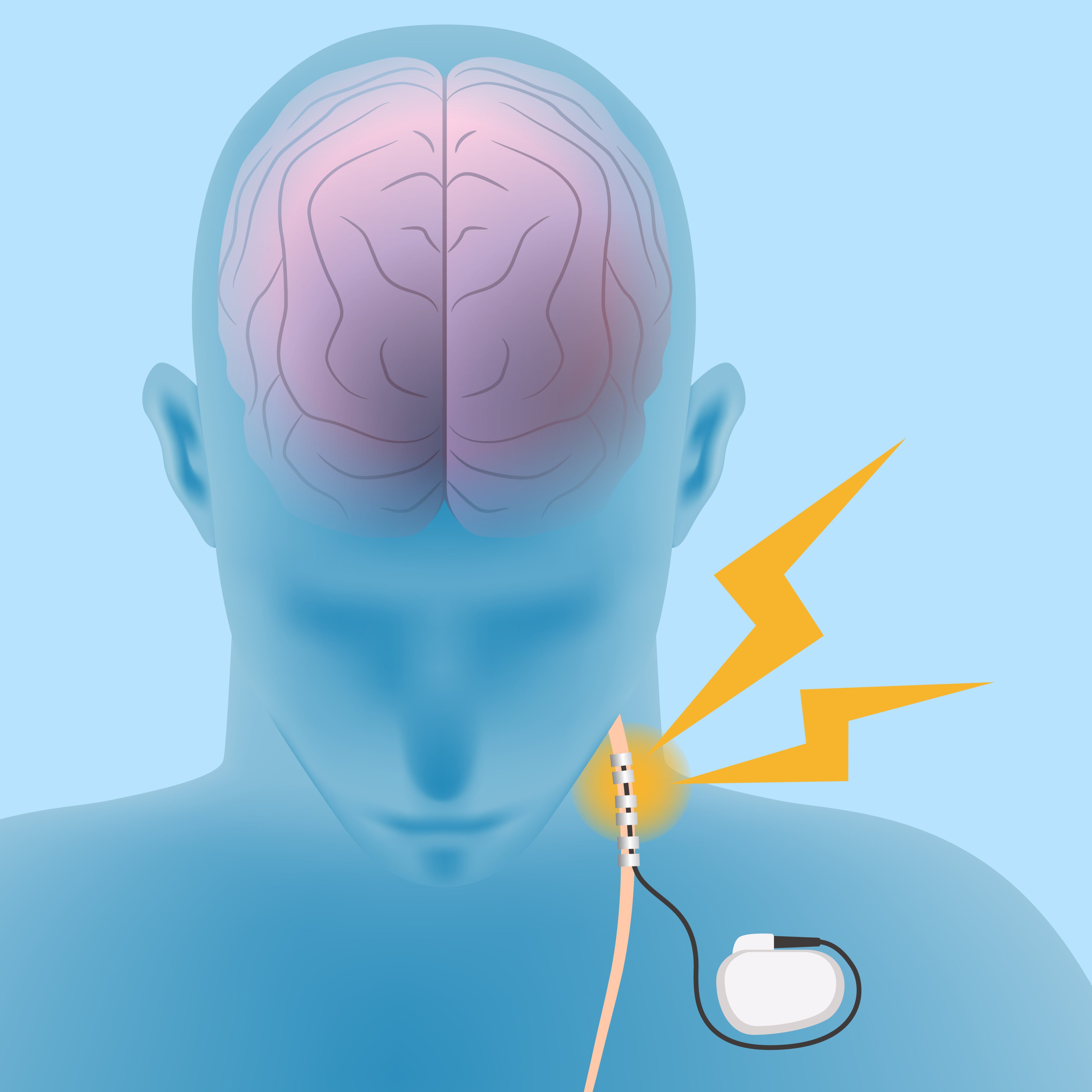 Invasive vagus nerve stimulation (VNS) uses a small device that is surgically implanted in the chest cavity near the collarbone to send electrical pulses to the vagus nerve which transmits those pulses to the brain.
Illustration: Shutterstock