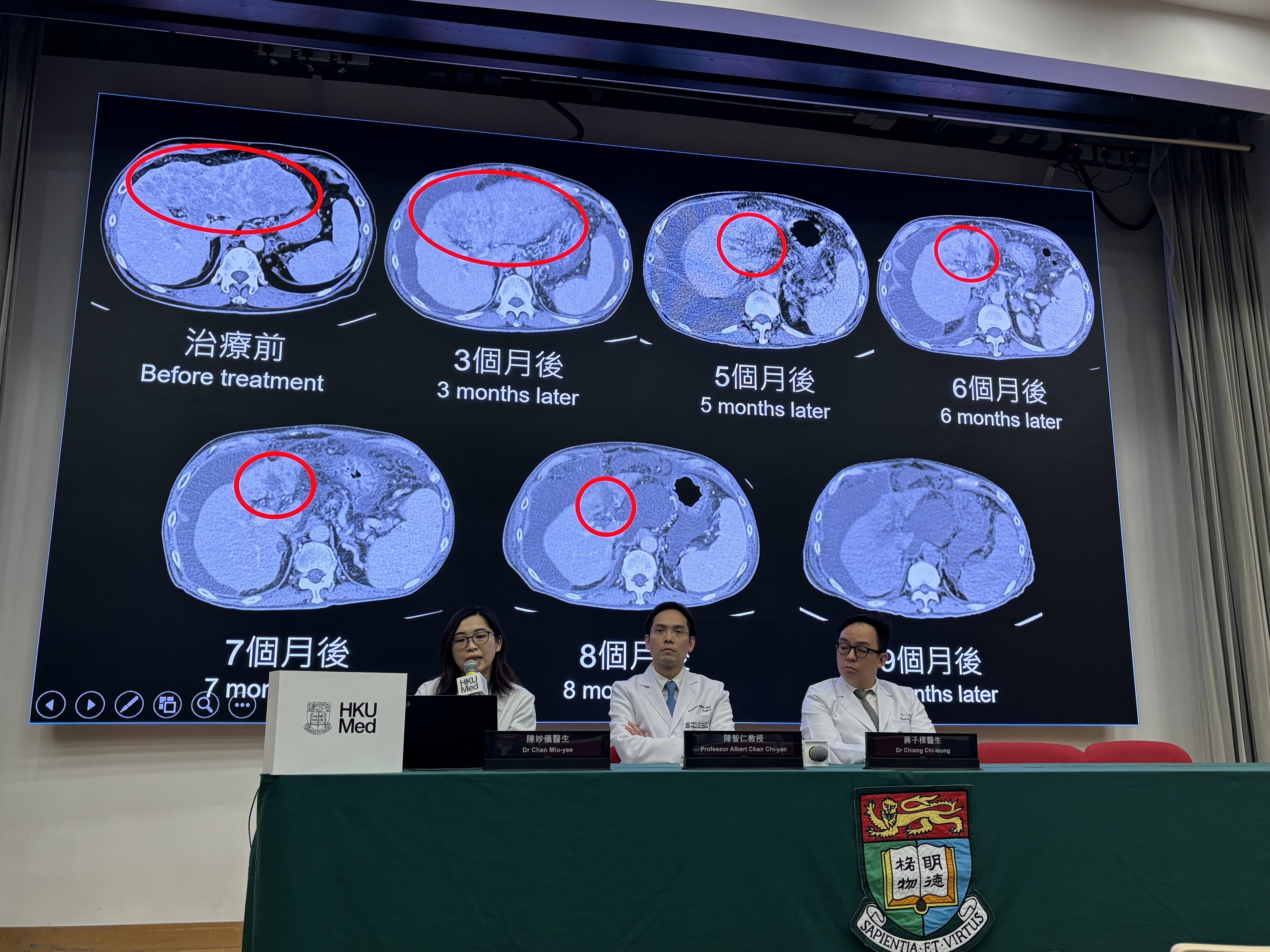 Professor Albert Chan (centre) with members of his team meet the press on Wednesday. “The team is honoured to provide new hope and possibilities for the treatment of liver cancer,” he said. Photo: Connor Mycroft