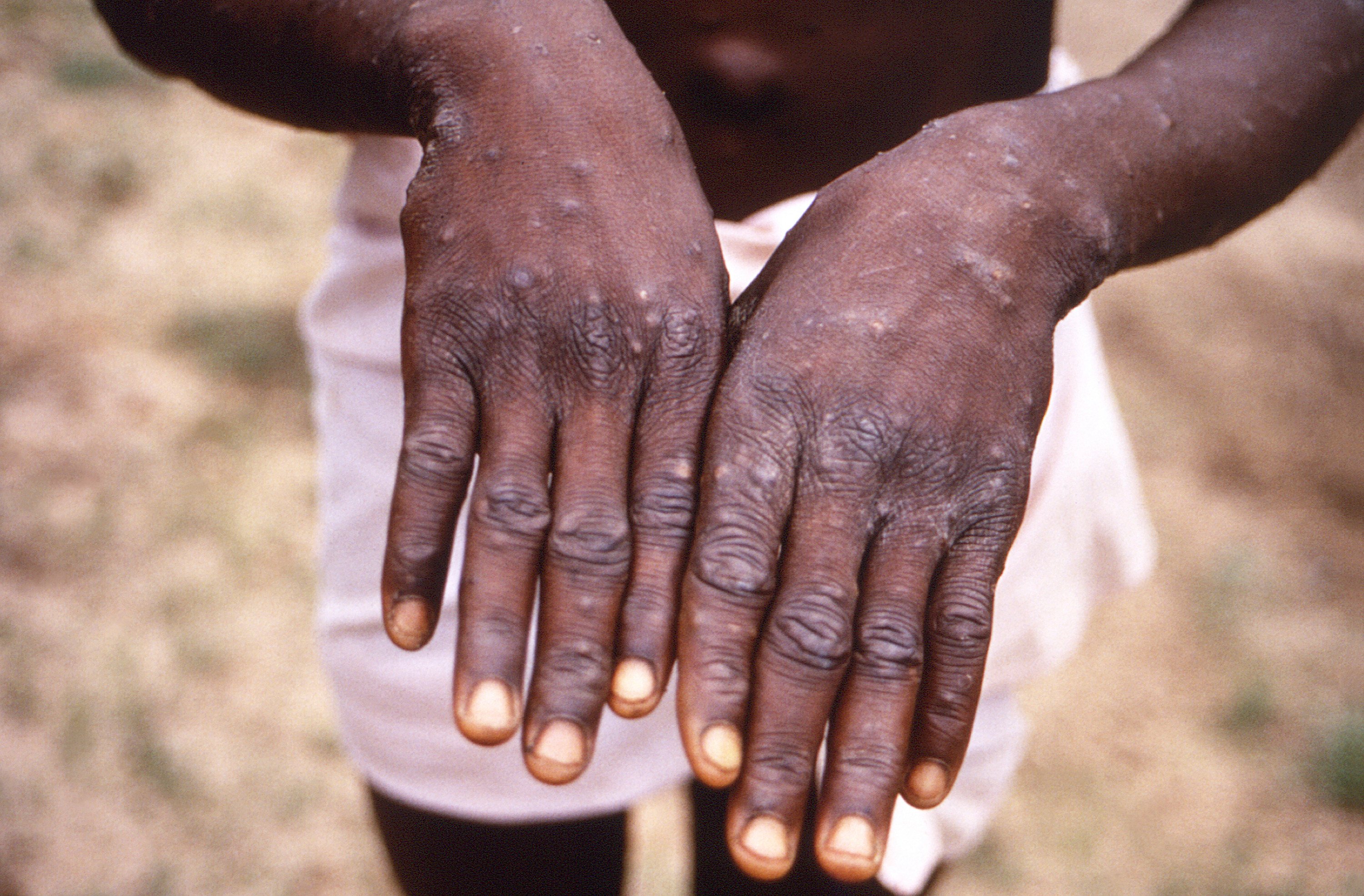 The characteristic rash of mpox is seen on the hands of a patient. As Congo copes with its biggest outbreak of mpox, scientists warn discrimination against gay and bisexual men on the continent could make it worse. File photo: CDC via AP