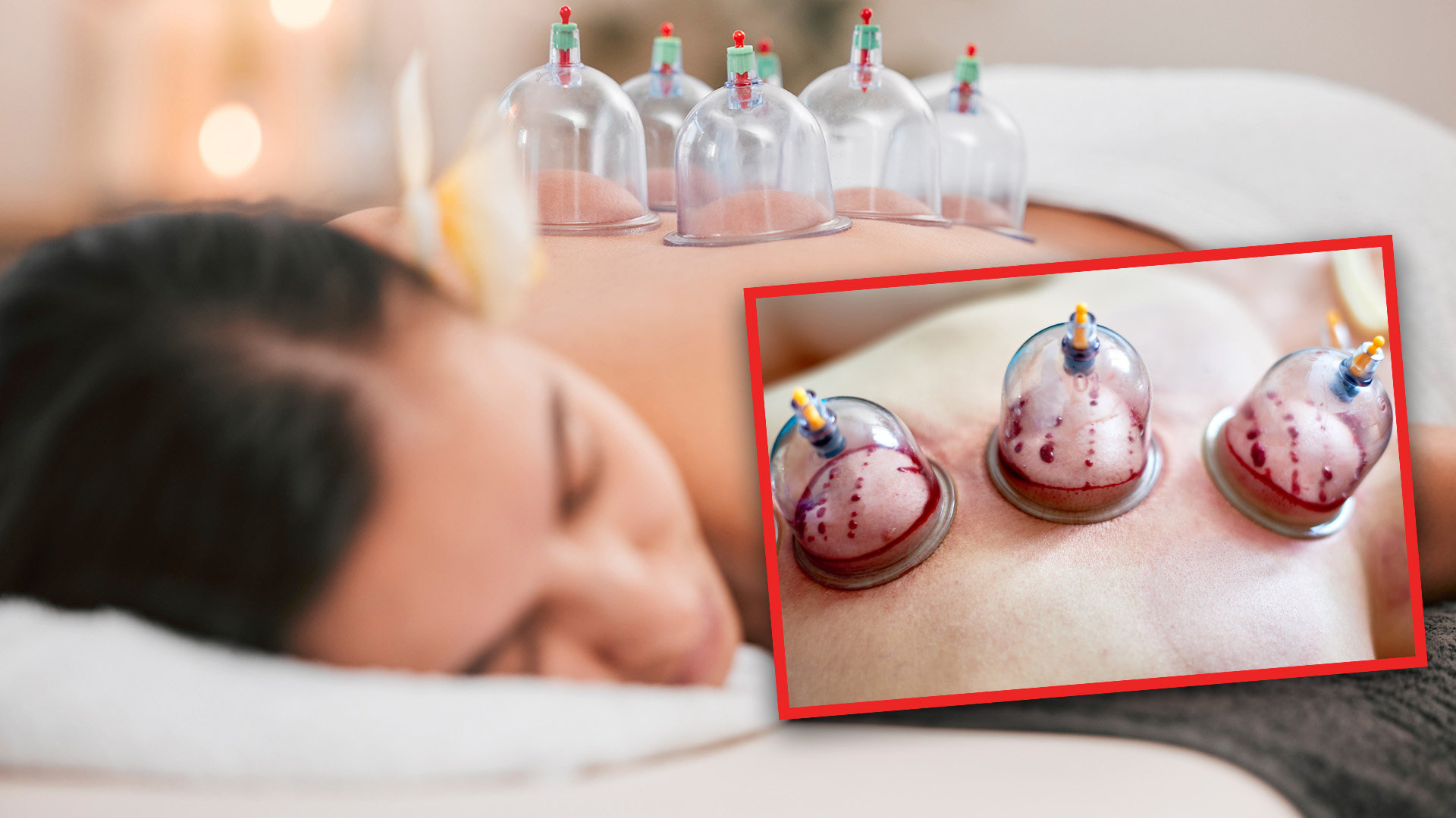 A woman in China had to be rushed to hospital suffering from severe anaemia due to the long term effects of two year’s worth of traditional bloodletting and cupping treatments. Photo: SCMP composite/Shutterstock